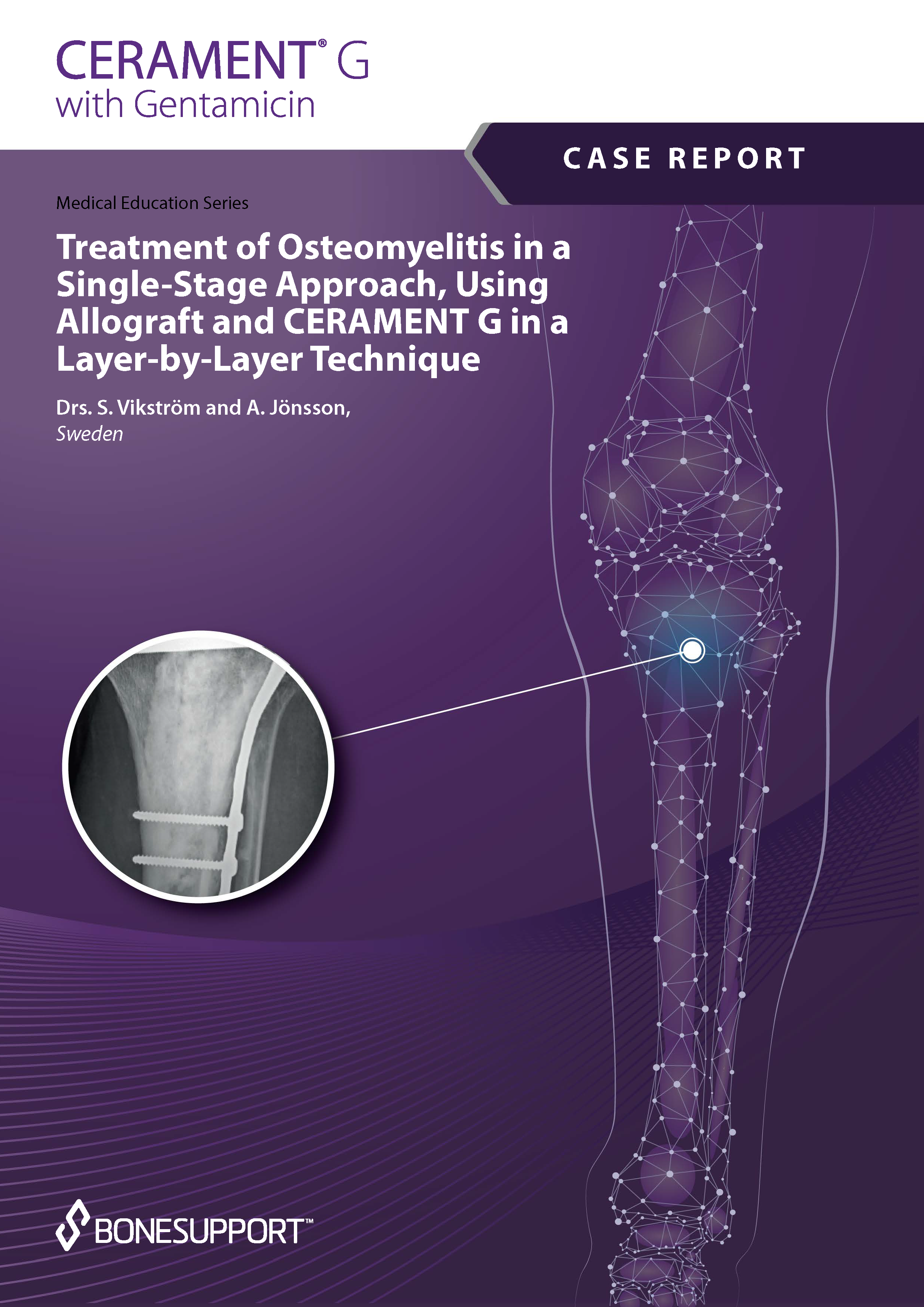 Vikstrom – Treatment of osteomyelitis in a single-stage approach, using allograft and CERAMENT™|G in a layer-by-layer technique