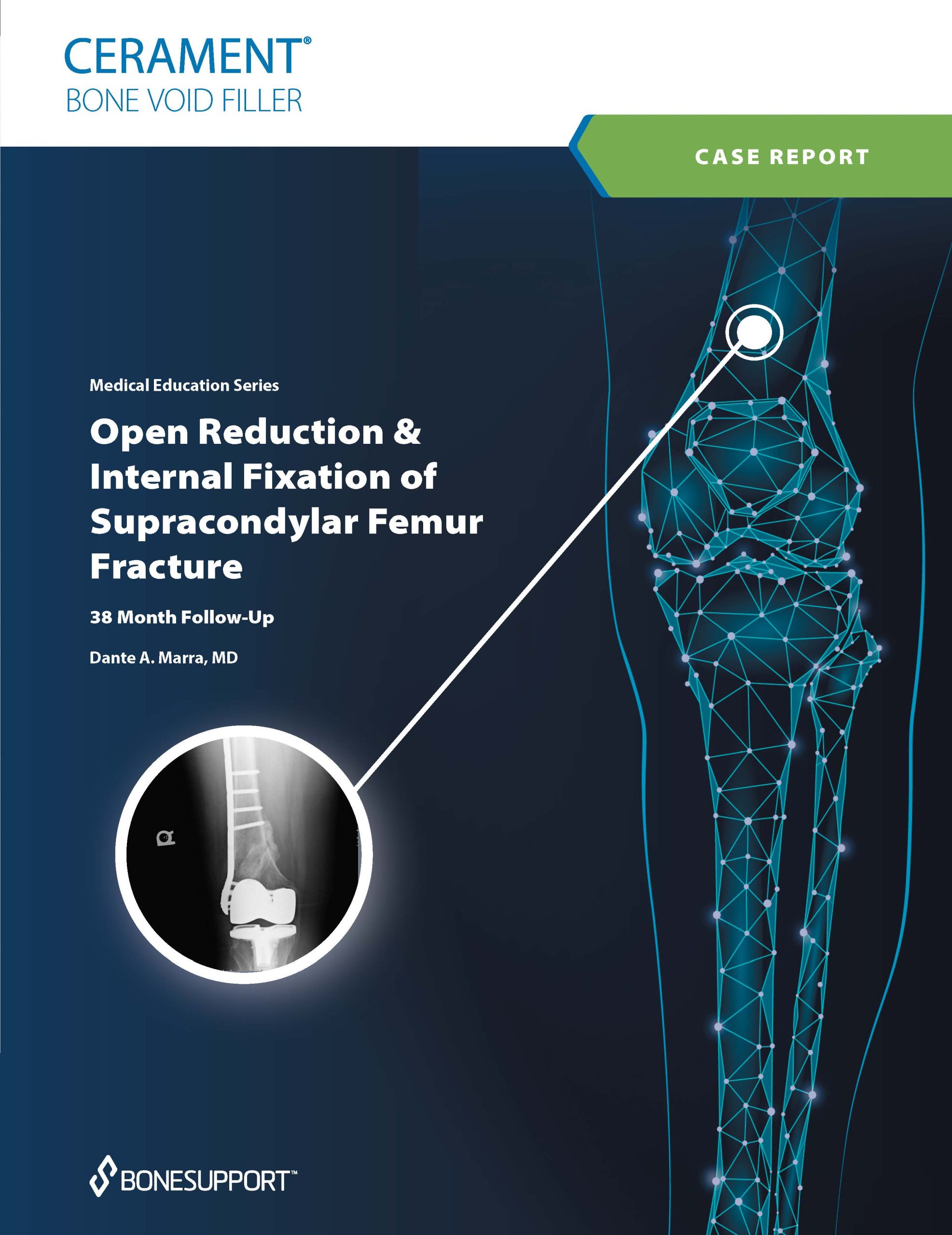 Open Reduction and Internal Fixation of a Supracondylar Femur Fracture with CERAMENT®|BONE VOID FILLER