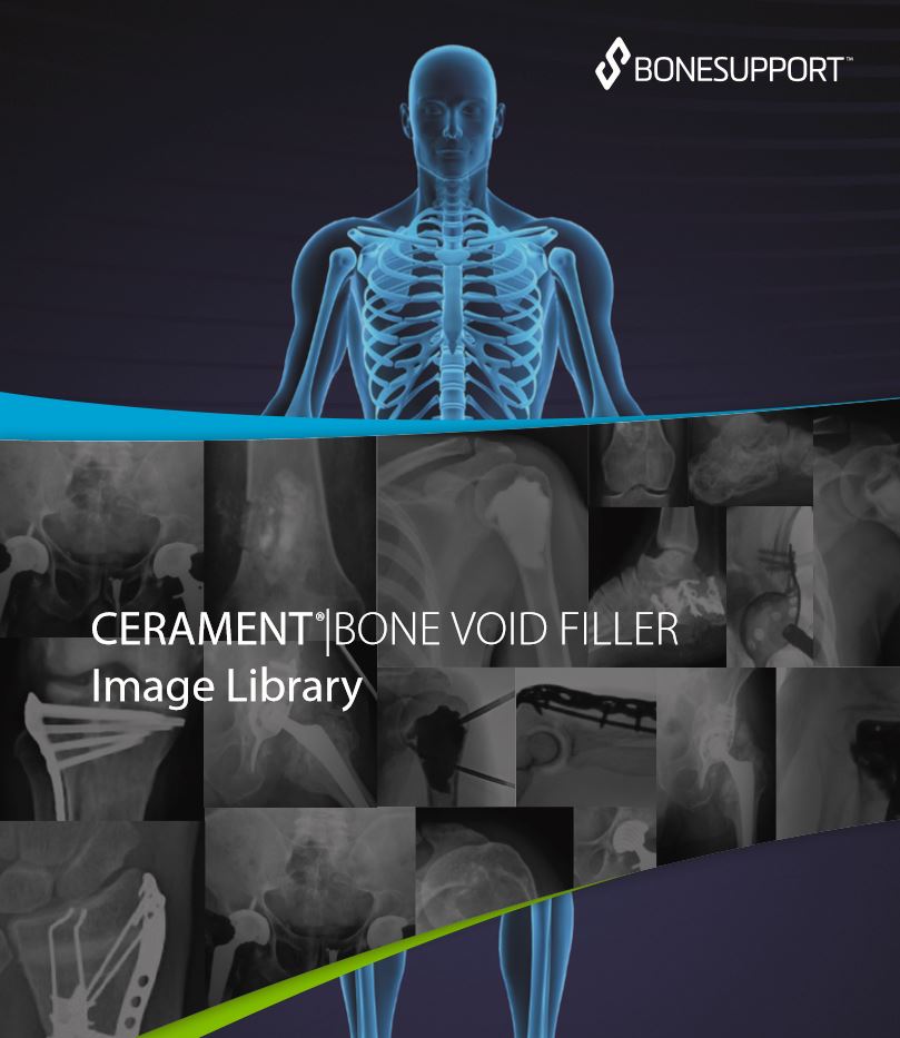 CERAMENT BONE VOID FILLER Image Library