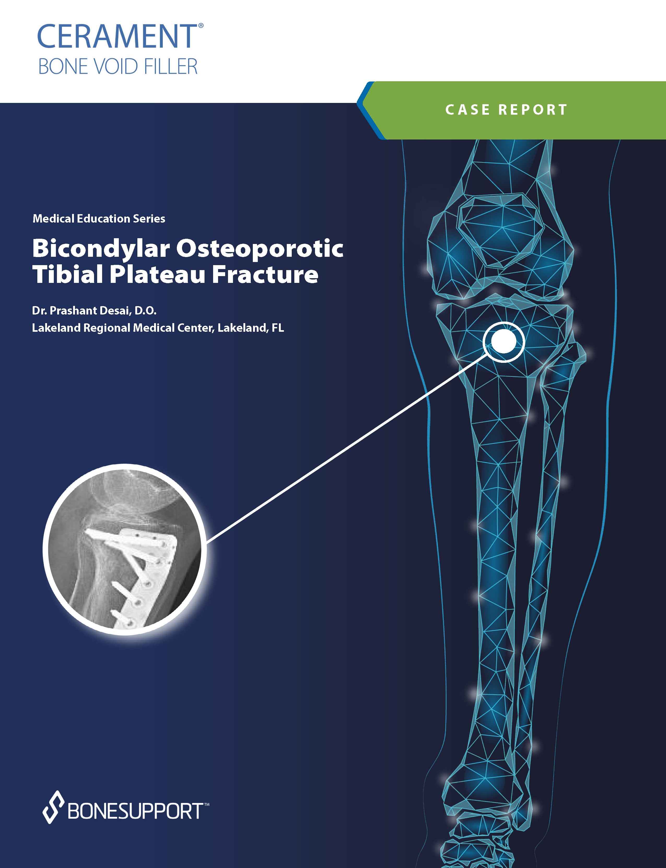 Dr. Desai –  Bicondylar Osteoporotic Tibial Plateau Fracture