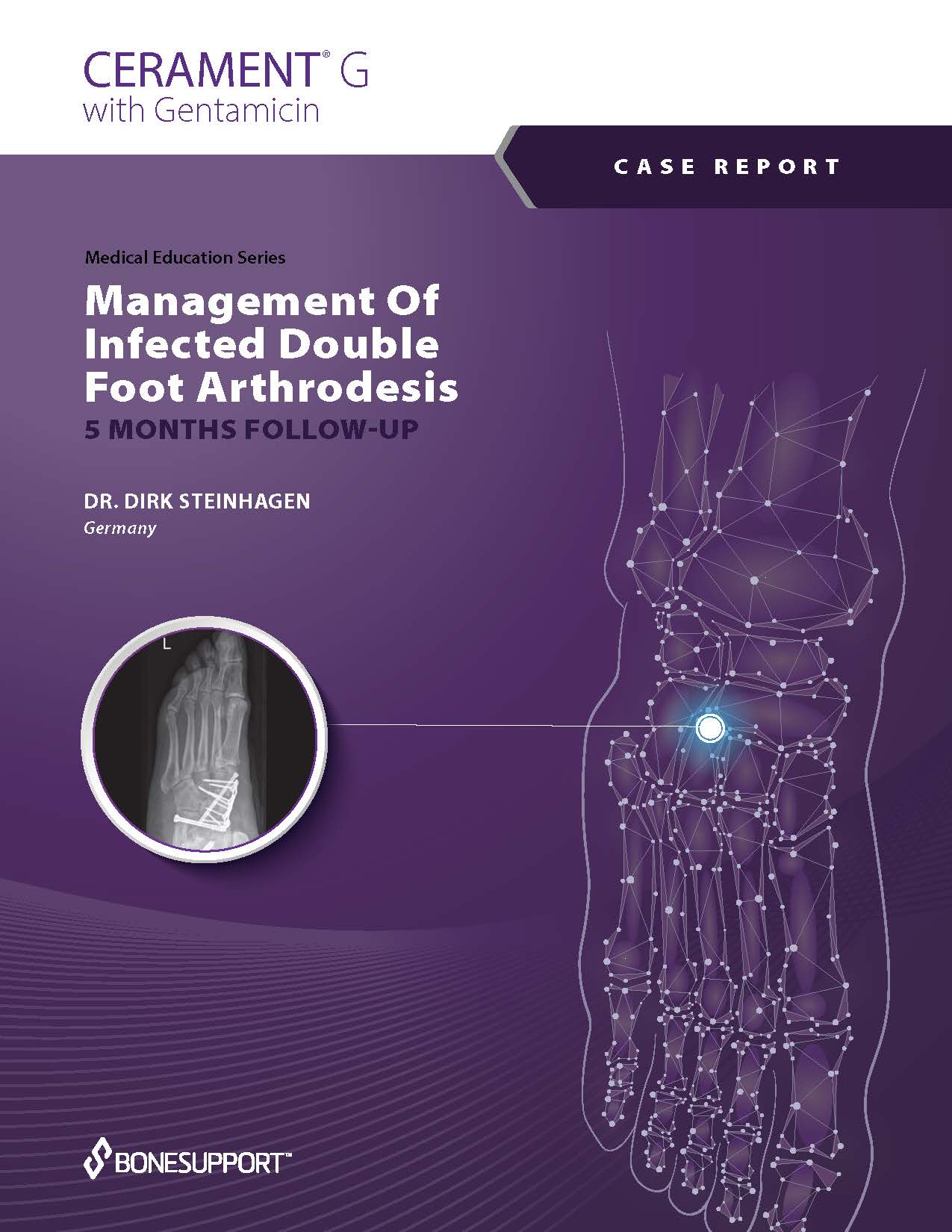 Management of infected double foot arthrodesis with CERAMENT G – 5 months follow up