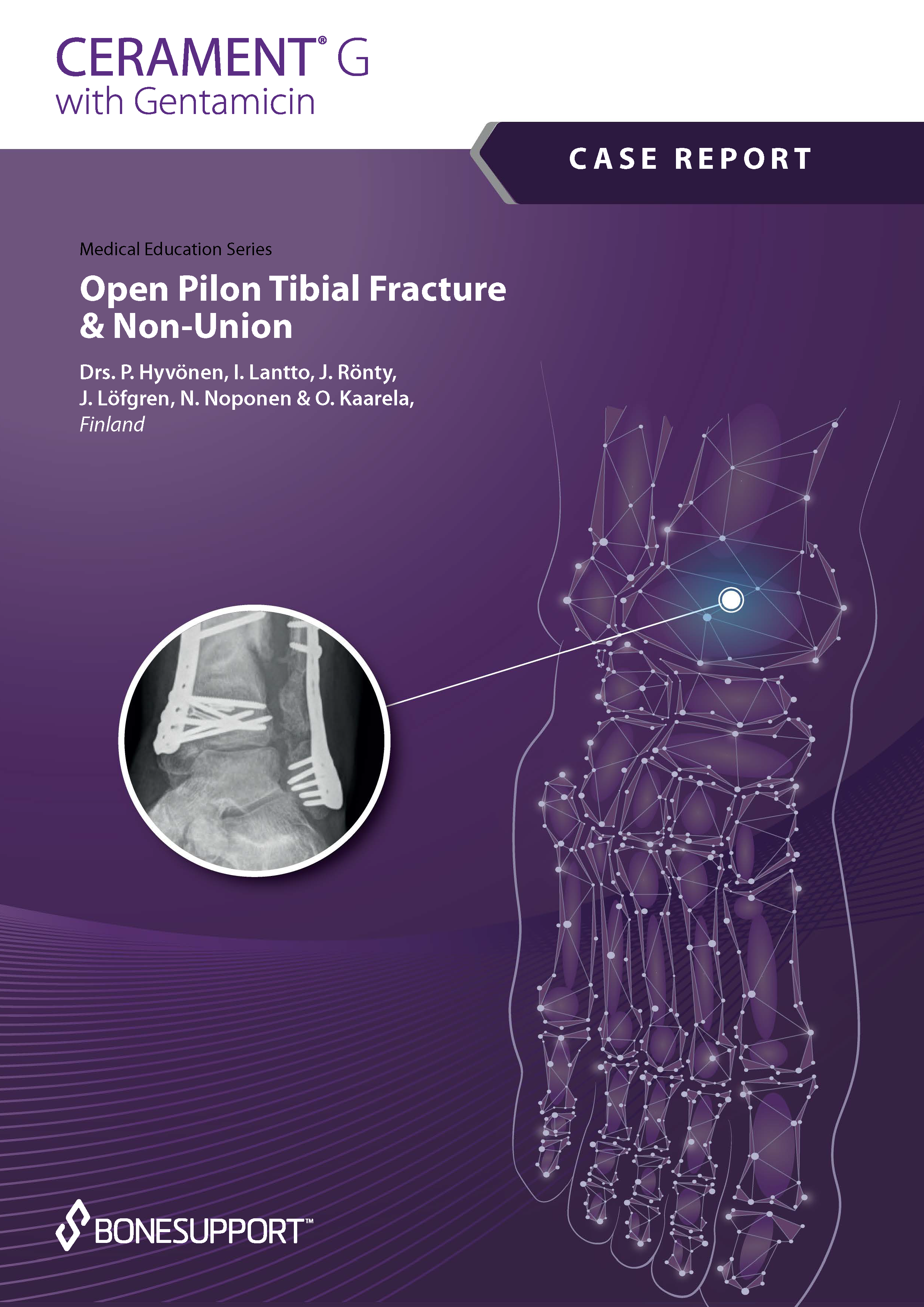 Open pilon tibial fracture & non-union