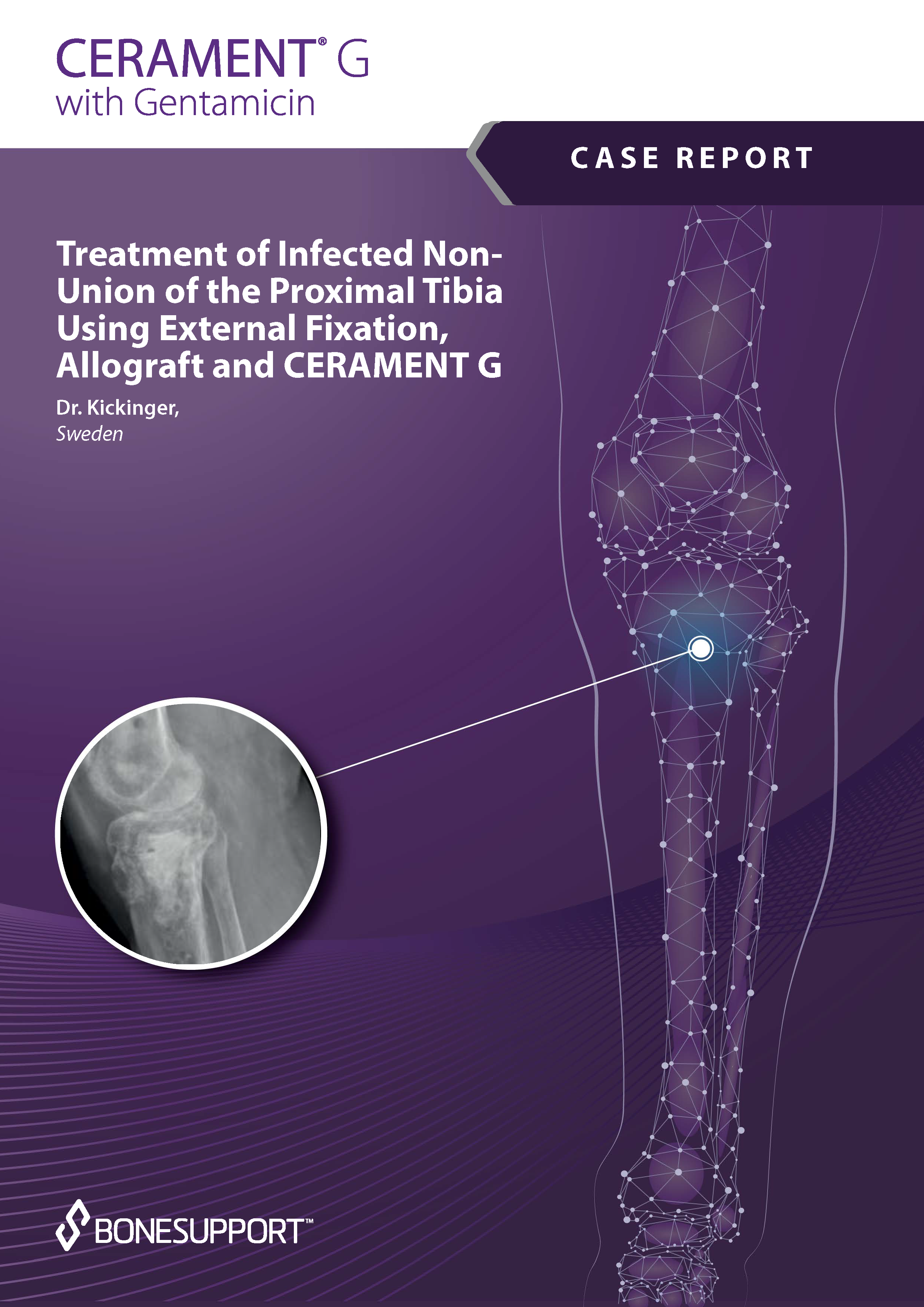 Treatment of infected non-union of the proximal tibia using external fixation, allograft and CERAMENT G
