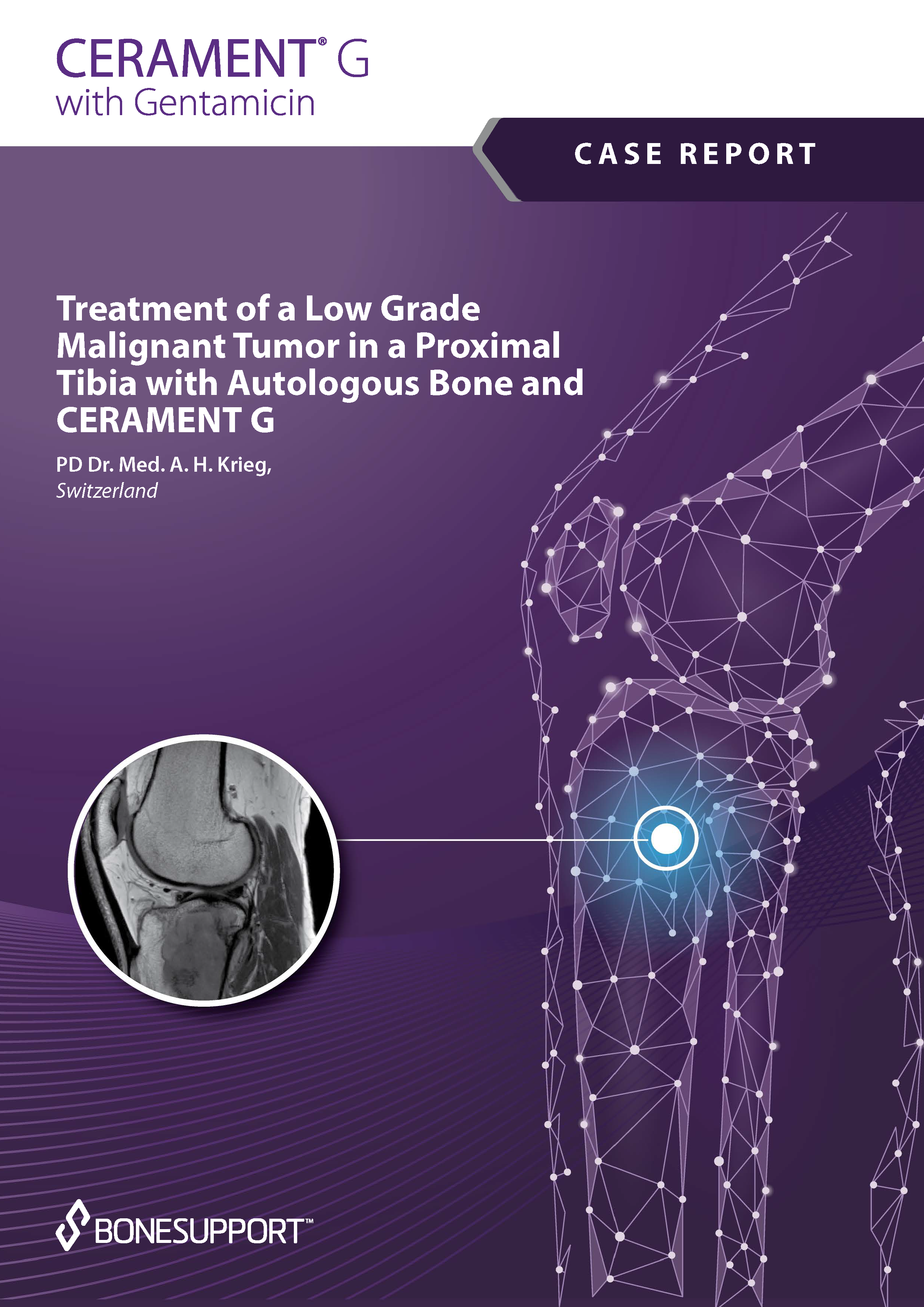 Treatment of a low grade malignant tumor in a proximal tibia with autologous bone and CERAMENT G