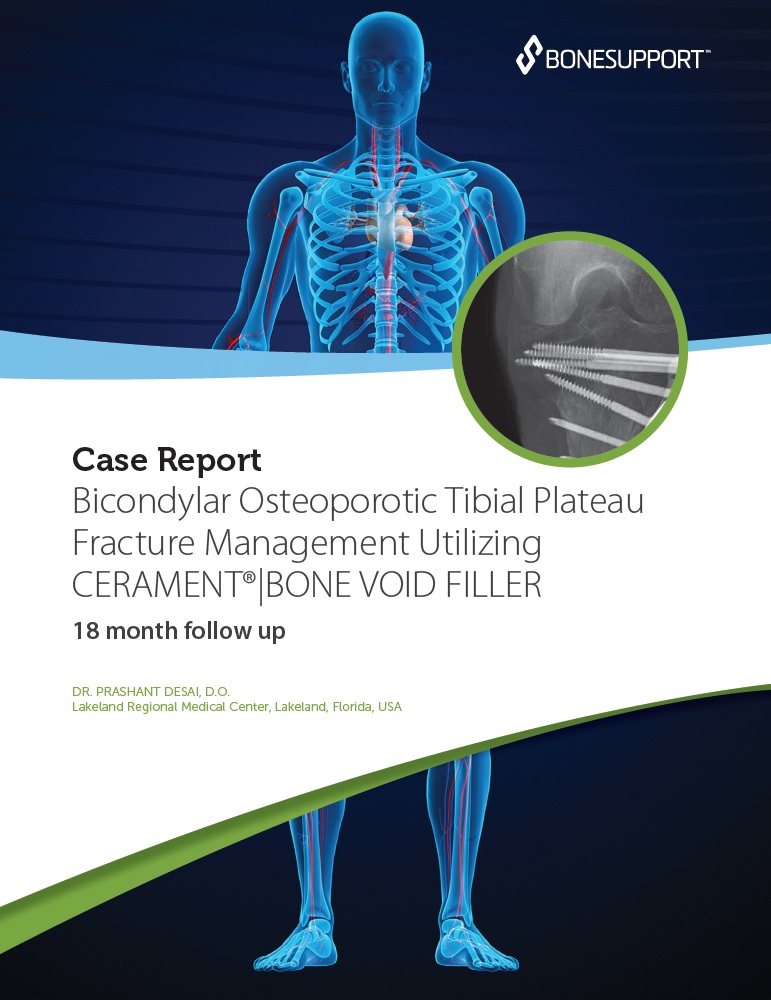 Dr. Desai – Bicondylar osteoporotic tibial plateau fracture management utilizing CERAMENT BONE VOID FILLER
