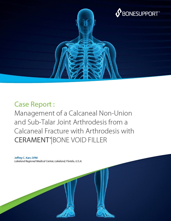 Management of a calcaneal non-union and sub-talar joint arthrodesis from a calcaneal fracture with arthrodesis with CERAMENT BONE VOID FILLER