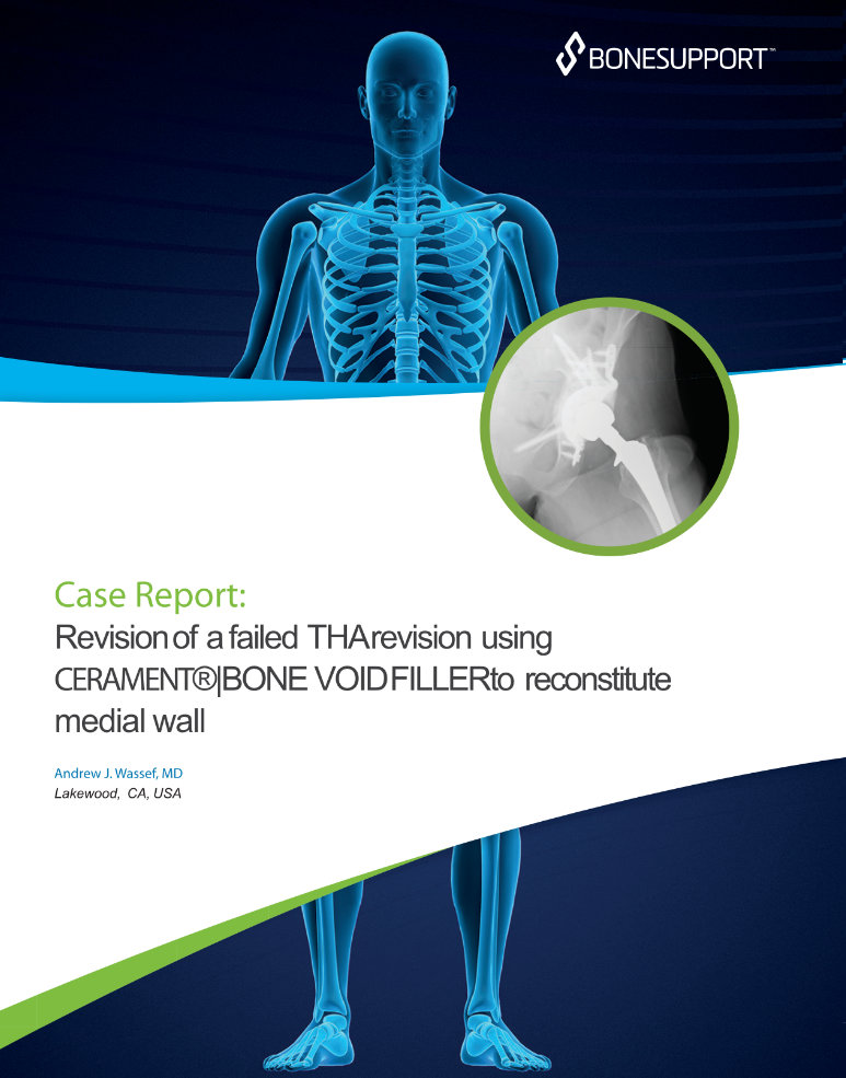 Wassef Revision of a failed THA revision using CERAMENT®|BONE VOID FILLER  to reconstitute medial wall