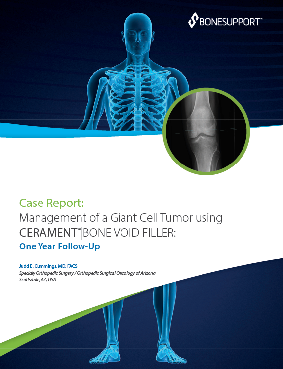 Management of a Giant Cell Tumor using CERAMENT BONE VOID FILLER