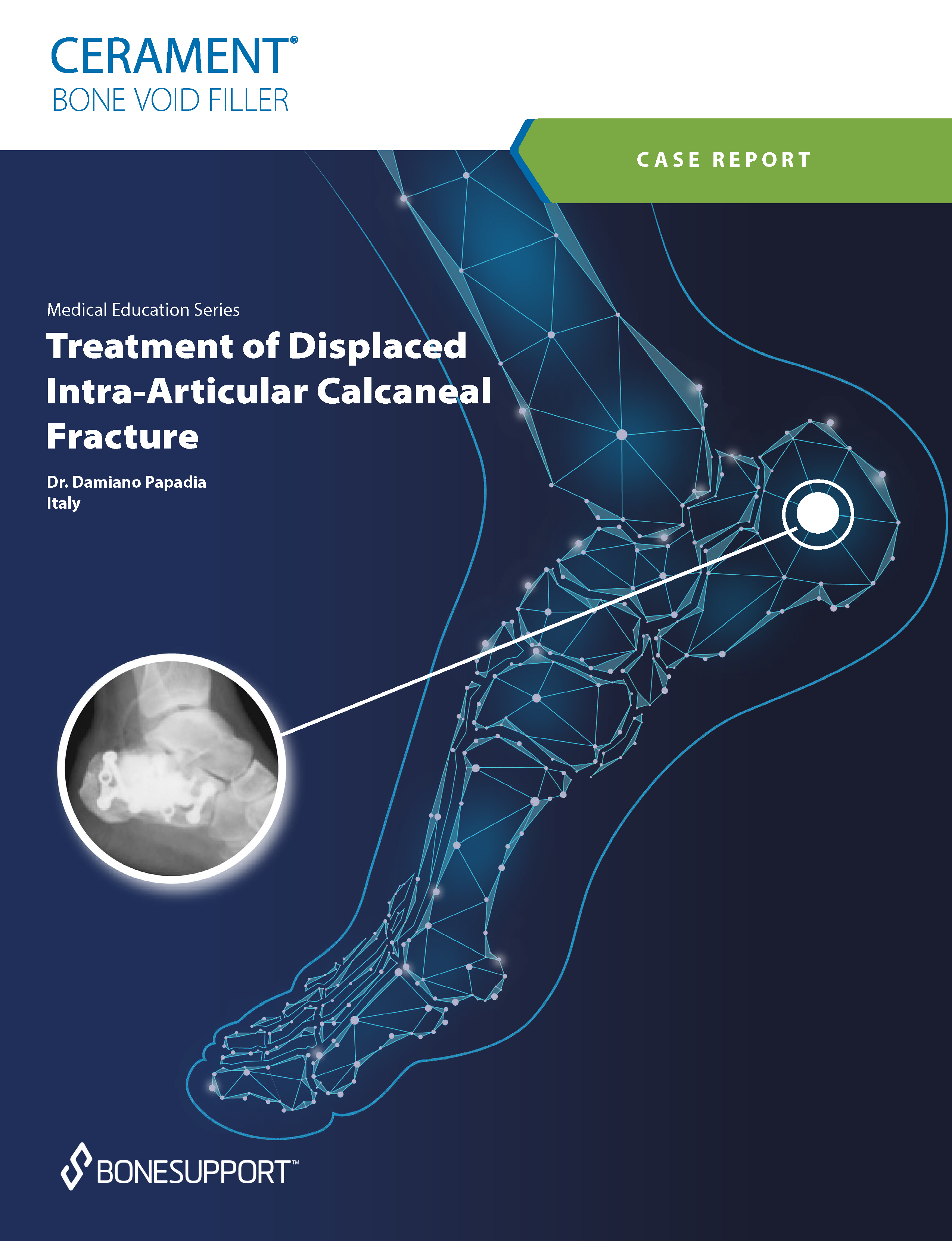 Treatment of Displaced Intra-Articular Calcaneal Fracture