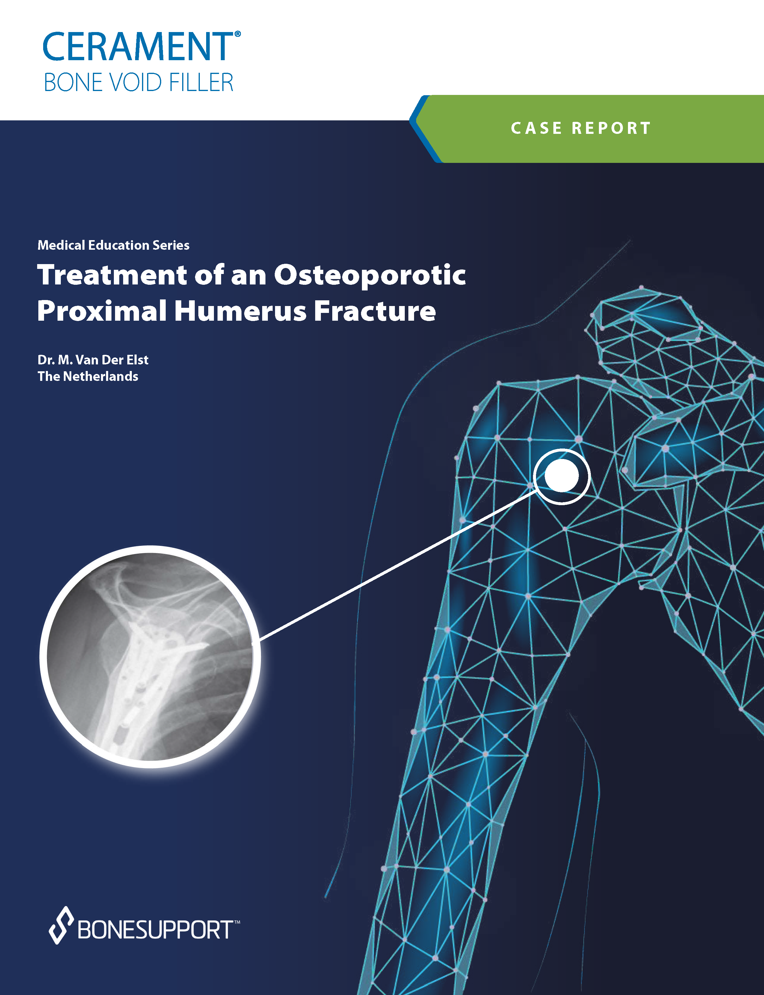 Van der Elst Treatment of an Osteoporotic Proximal Humerus Fracture