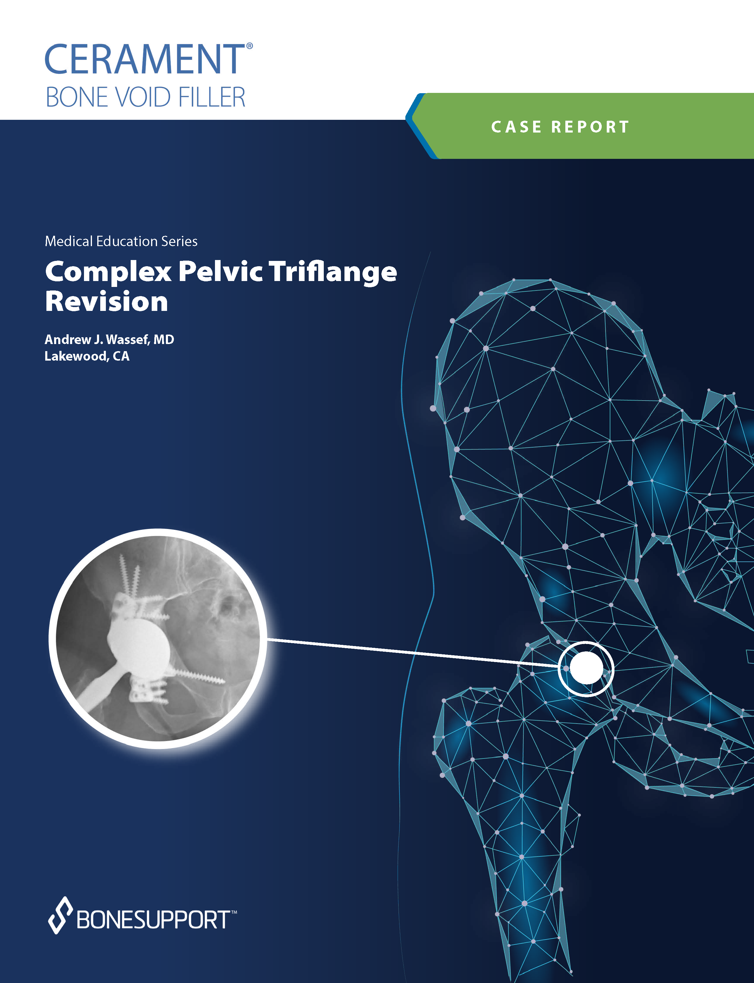 Complex Pelvic Triflange Revision