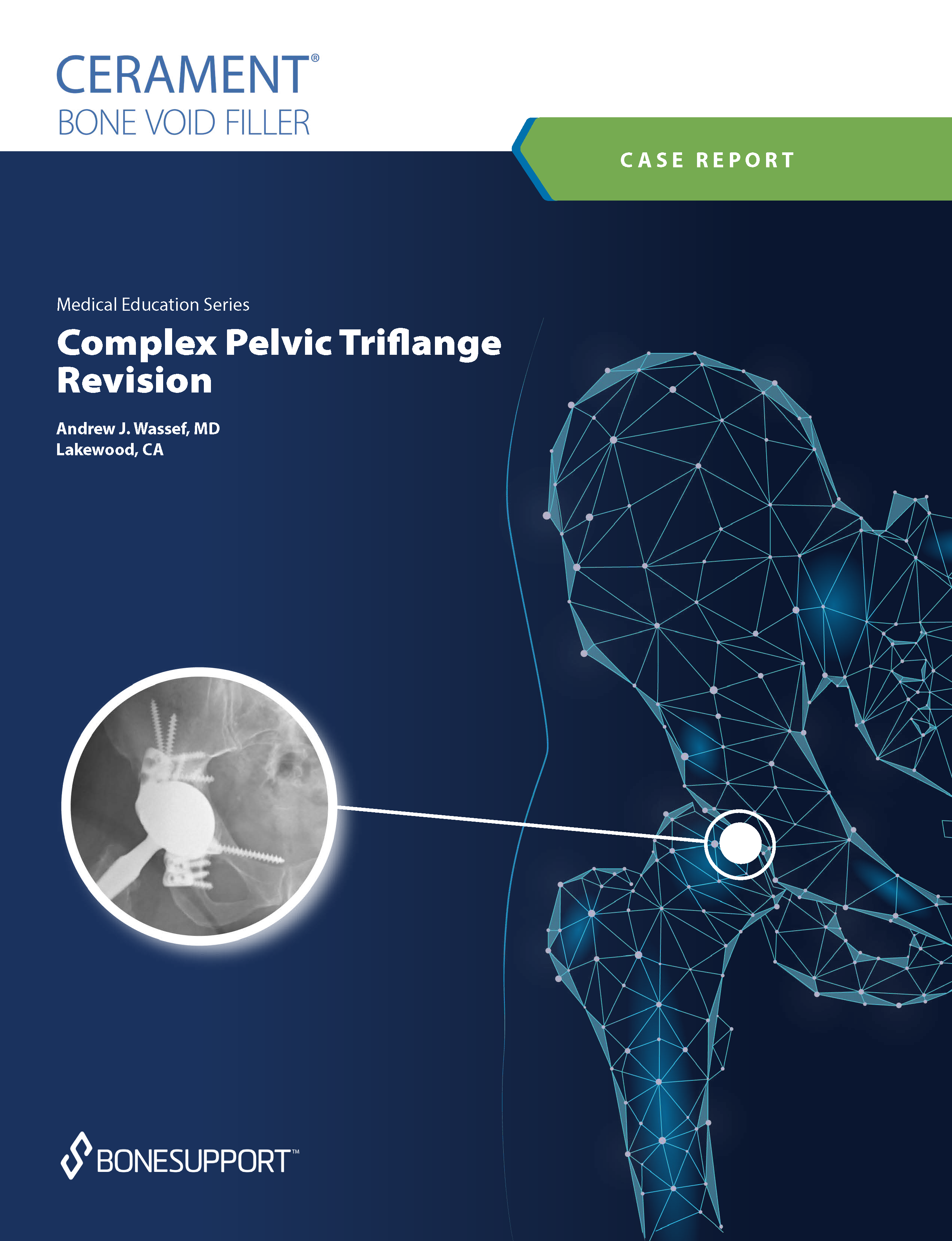 Wassef Complex Pelvic Triflange Revision