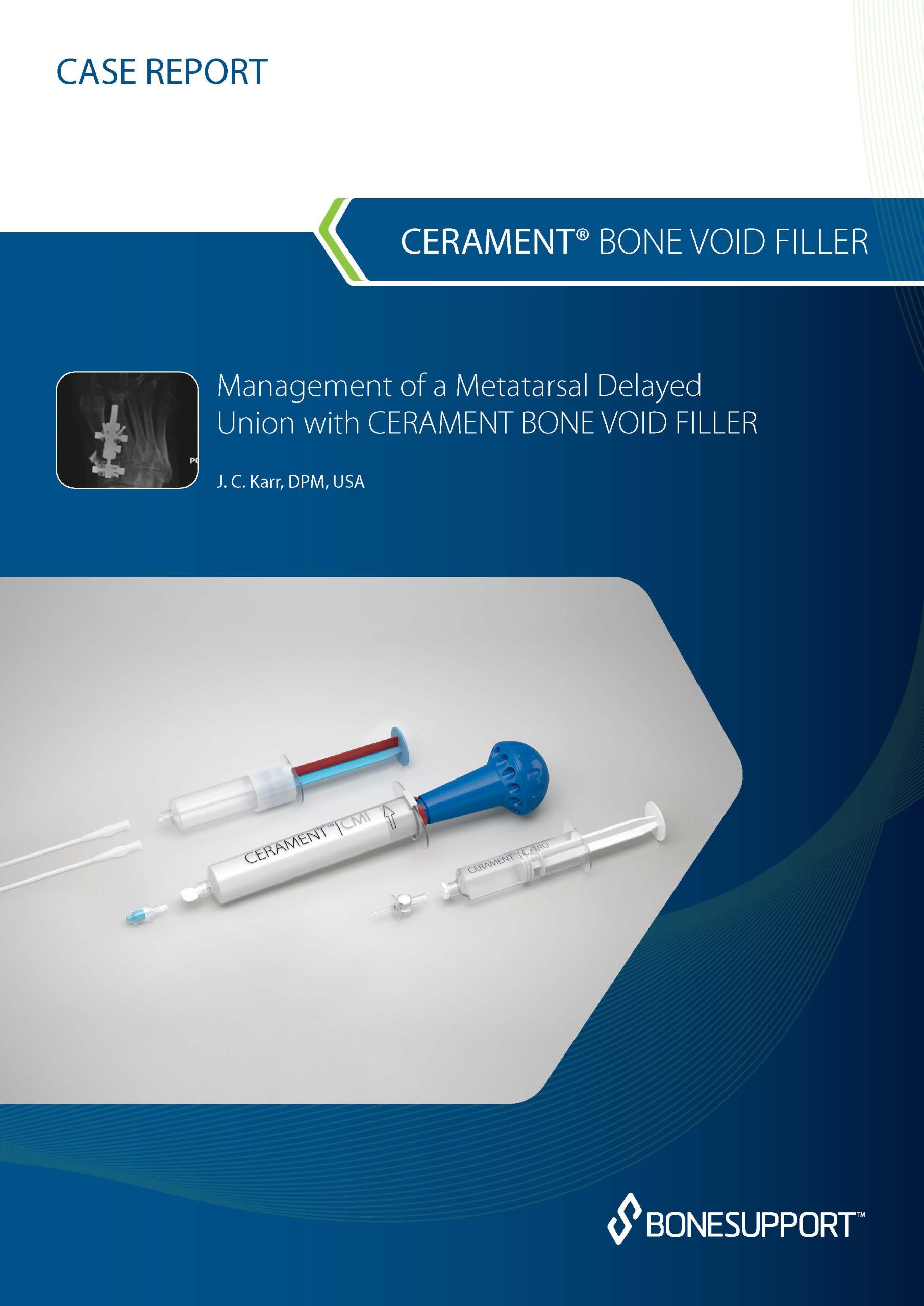 Management of a metatarsal delayed union with CERAMENT BONE VOID FILLER