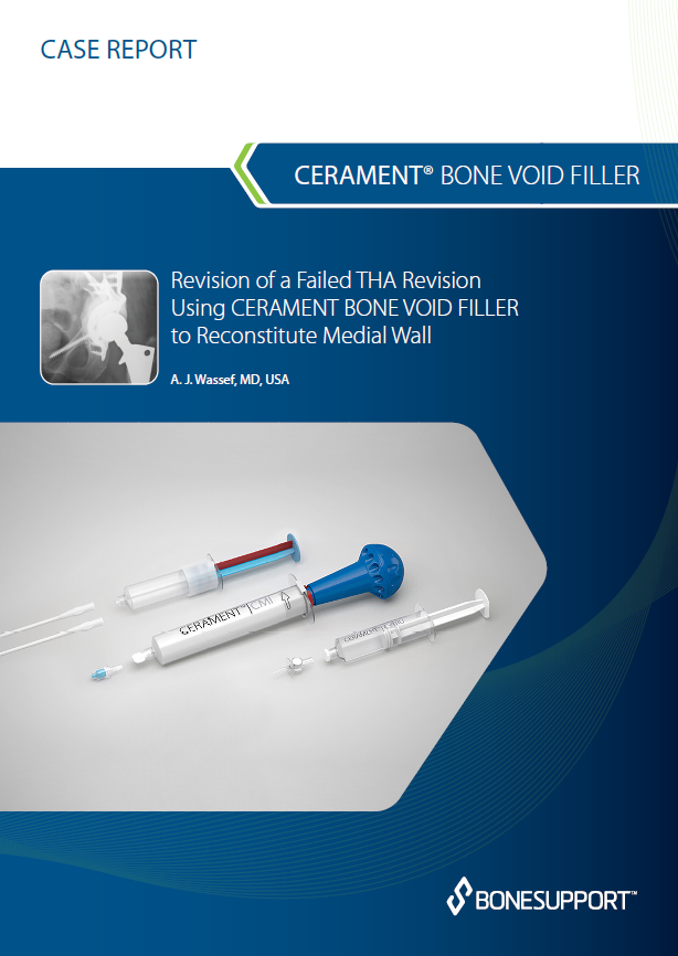 Wassef Revision of a failed THA revision using CBVF  to reconstitute medial wall