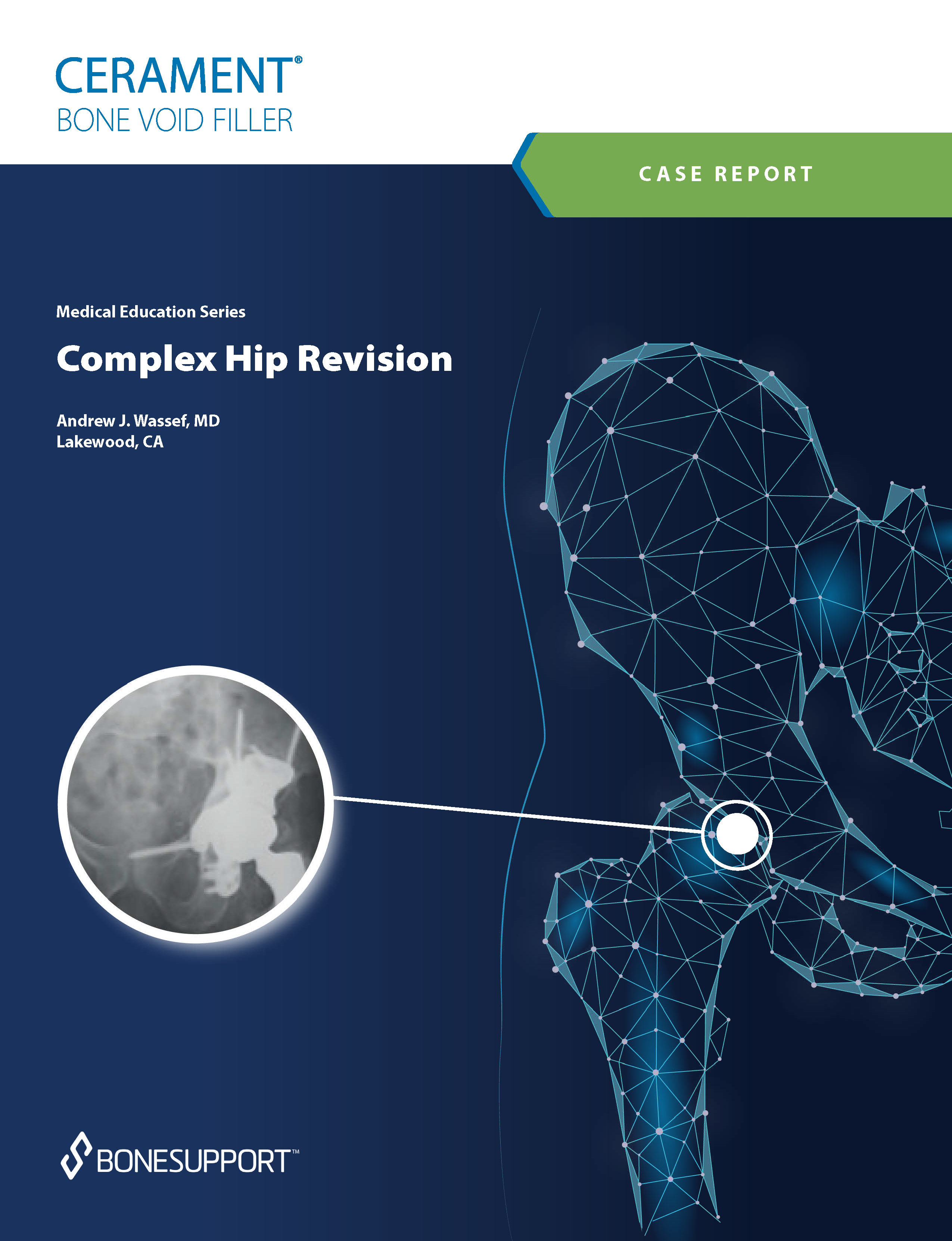 Wassef Complex Hip Revision