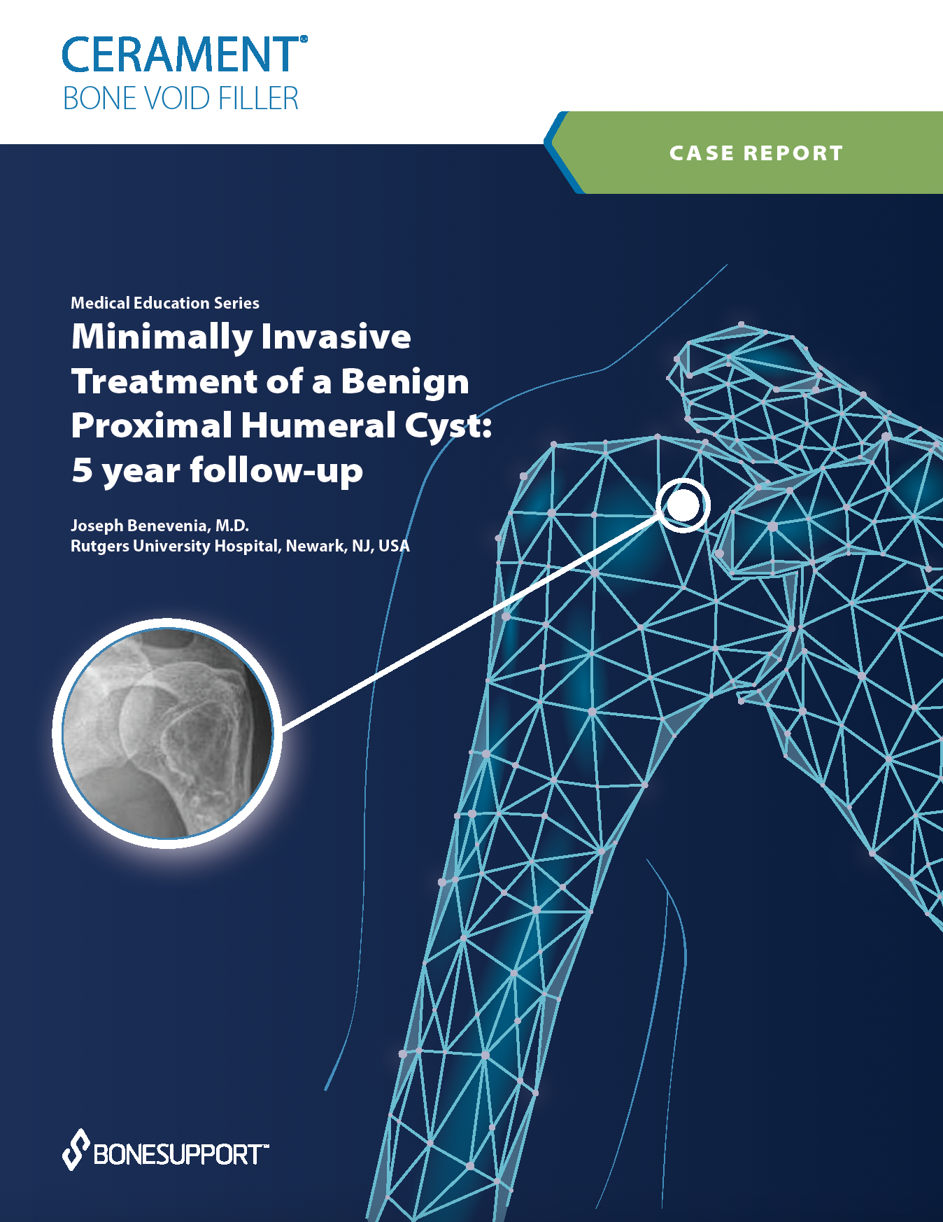 Minimally invasive treatment of a benign proximal humeral cyst with CERAMENT BONE VOID FILLER: 5 year follow-up