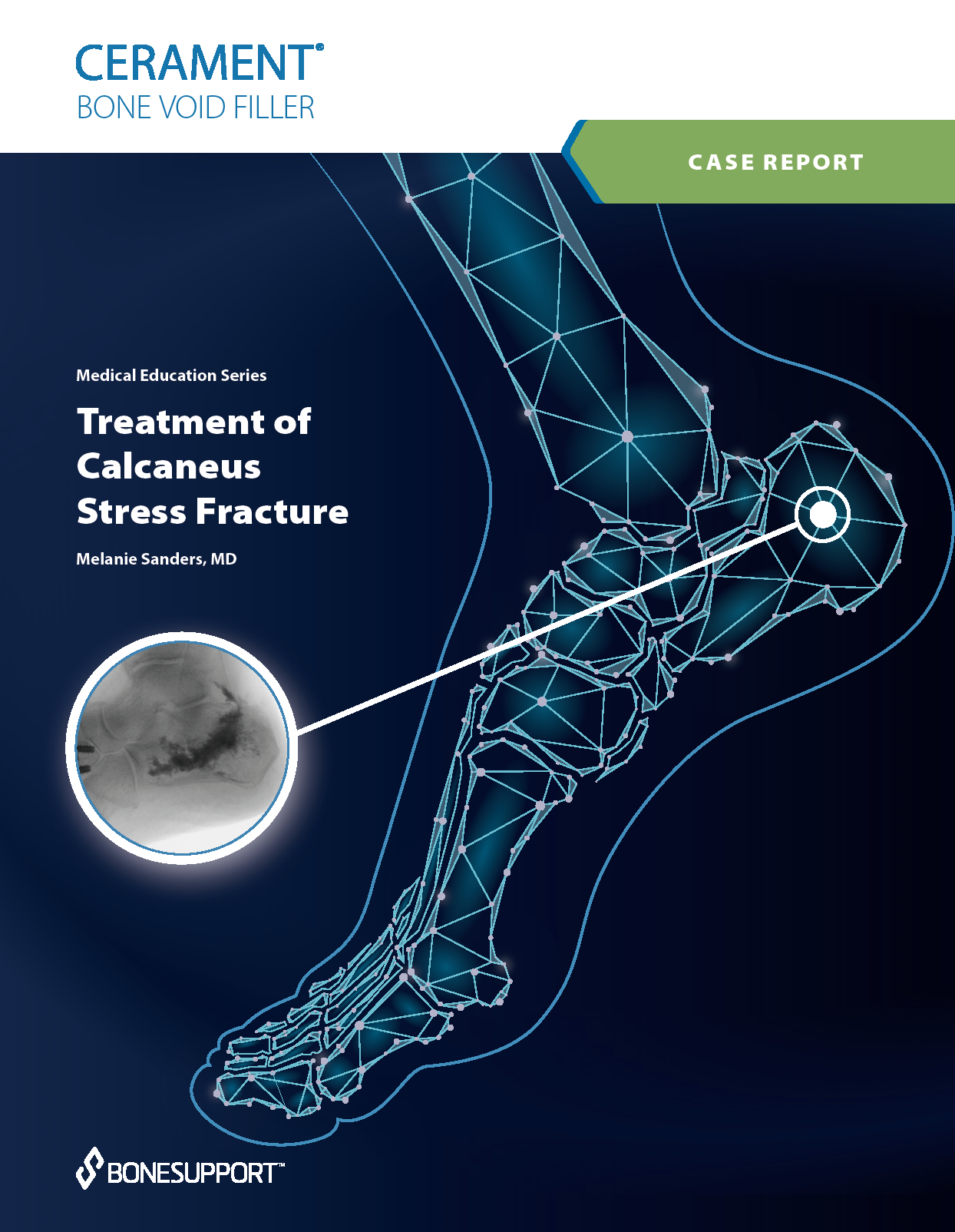 Melanie Sanders, MD – Treatment of Calcaneus Stress Fracture