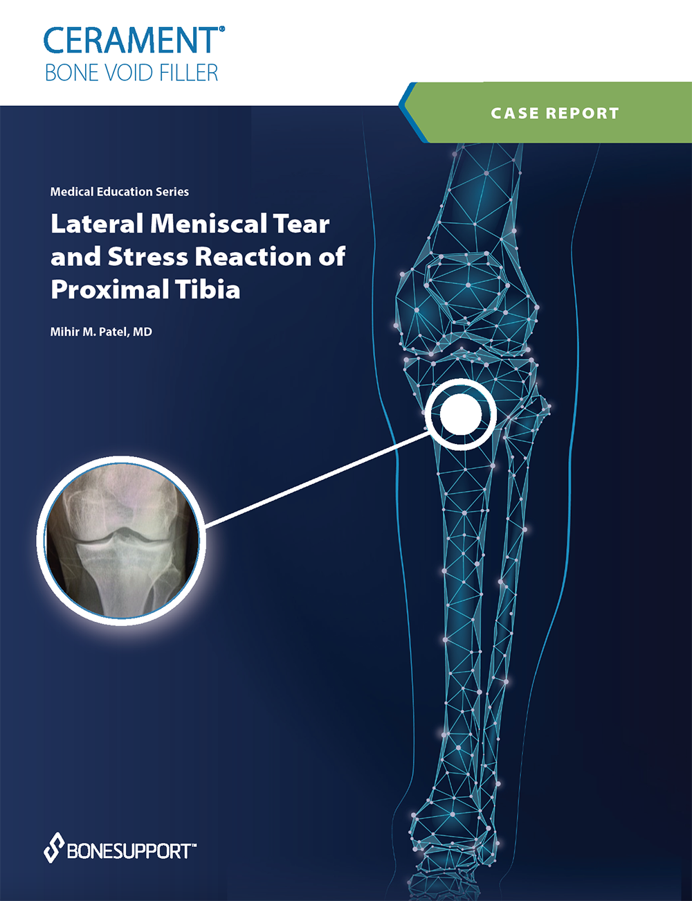 Patel Lateral Meniscal Tear and Stress Reaction of Proximal Tibia