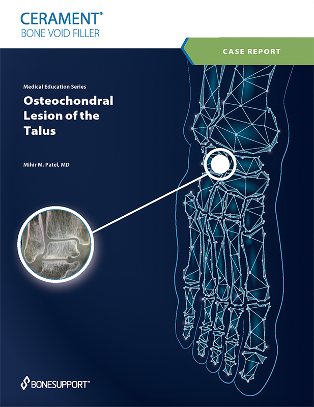 Osteochondral Lesion of the Talus