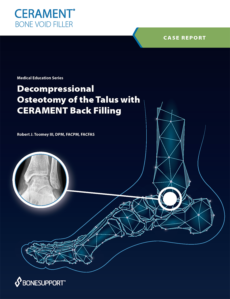 Decompressional Osteotomy of the Talus with CERAMENT Back Filling