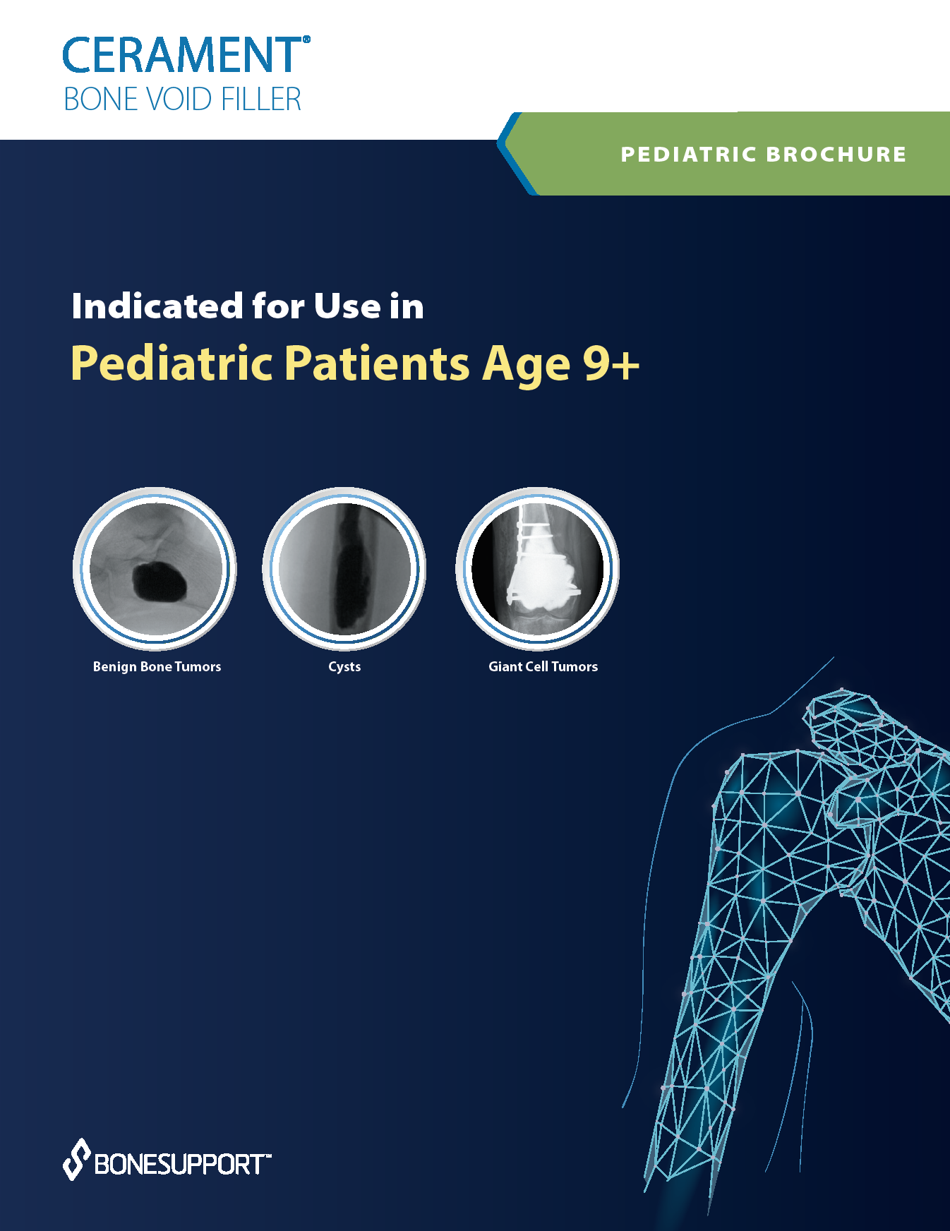 Pediatric Brochure – CERAMENT BONE VOID FILLER