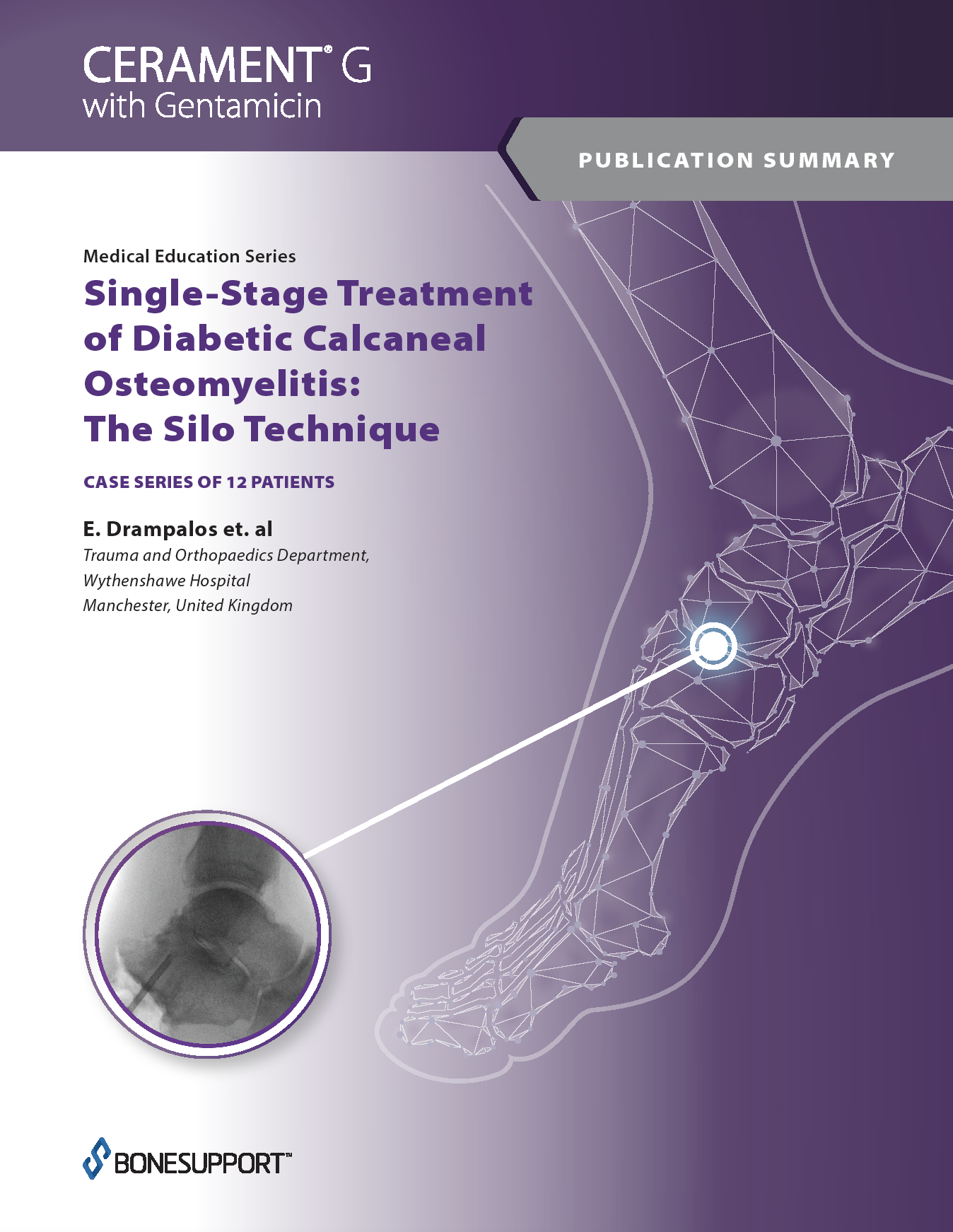 Drampalos et. al – Single-Stage Treatment of Diabetic Calcaneal Osteomyelitis: The Silo Technique 