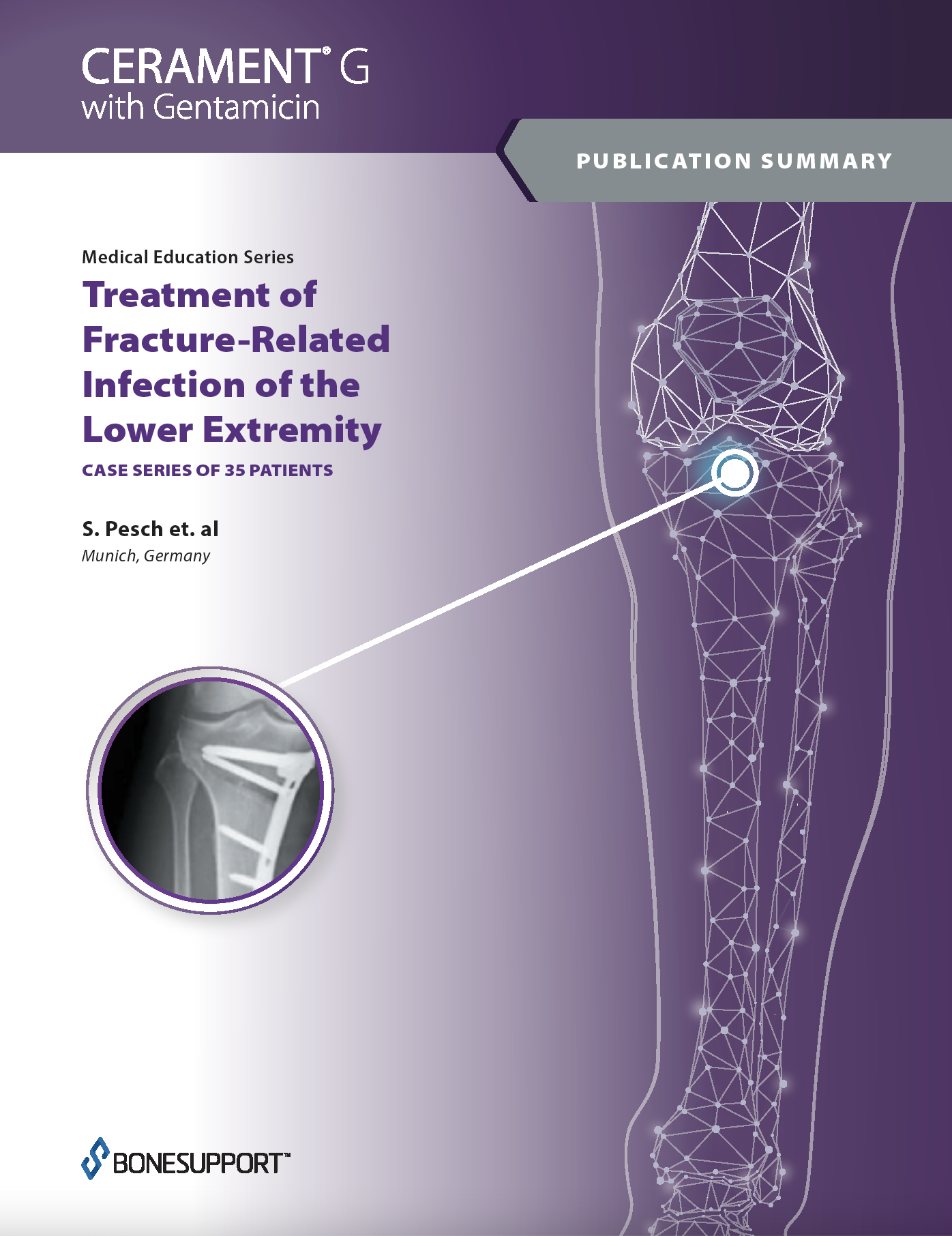 Treatment of Fracture-Related Infection of the Lower Extremity