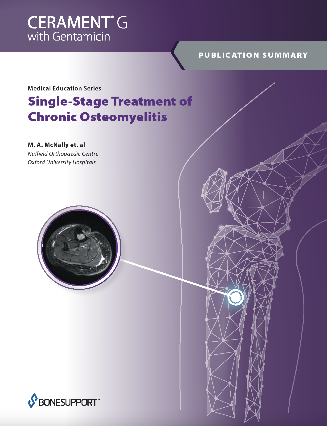 Single-Stage Treatment of Chronic Osteomyelitis