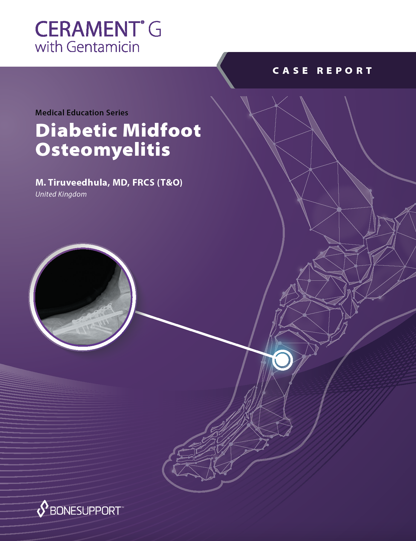 Diabetic Midfoot Osteomyelitis