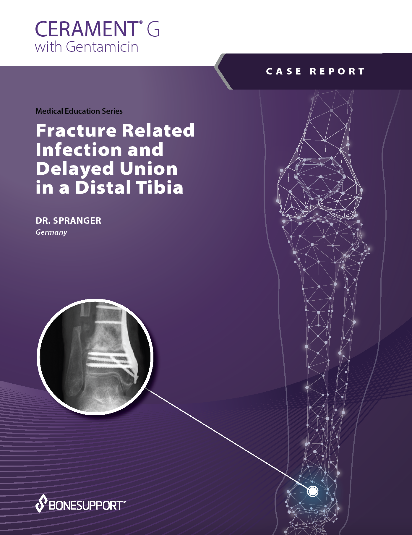 Dr. Spranger Fracture Related Infection and Delayed Union in a Distal Tibia