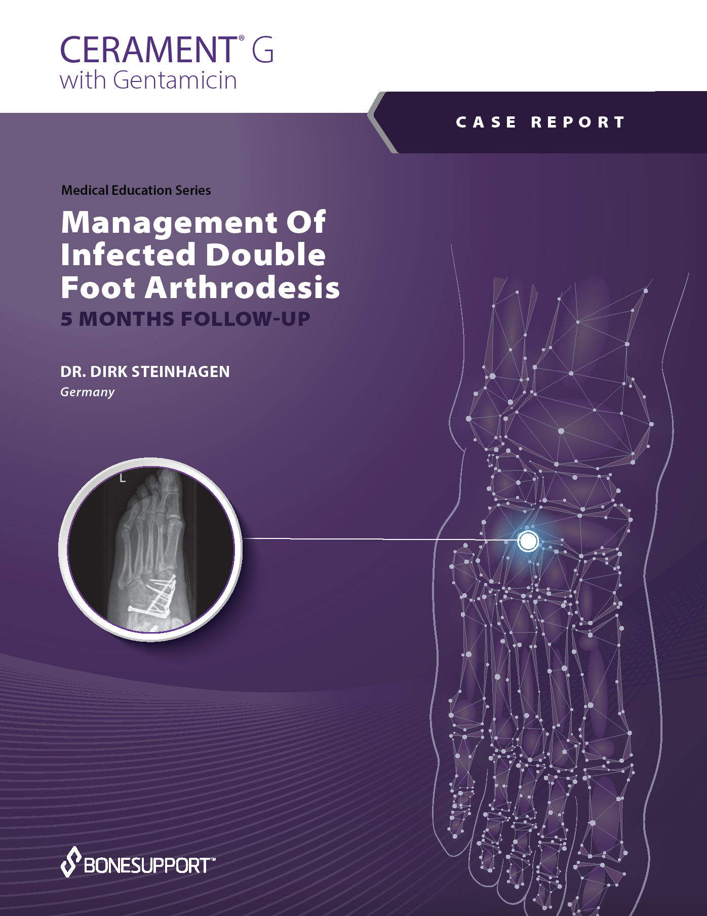 Management Of Infected Double Foot Arthrodesis