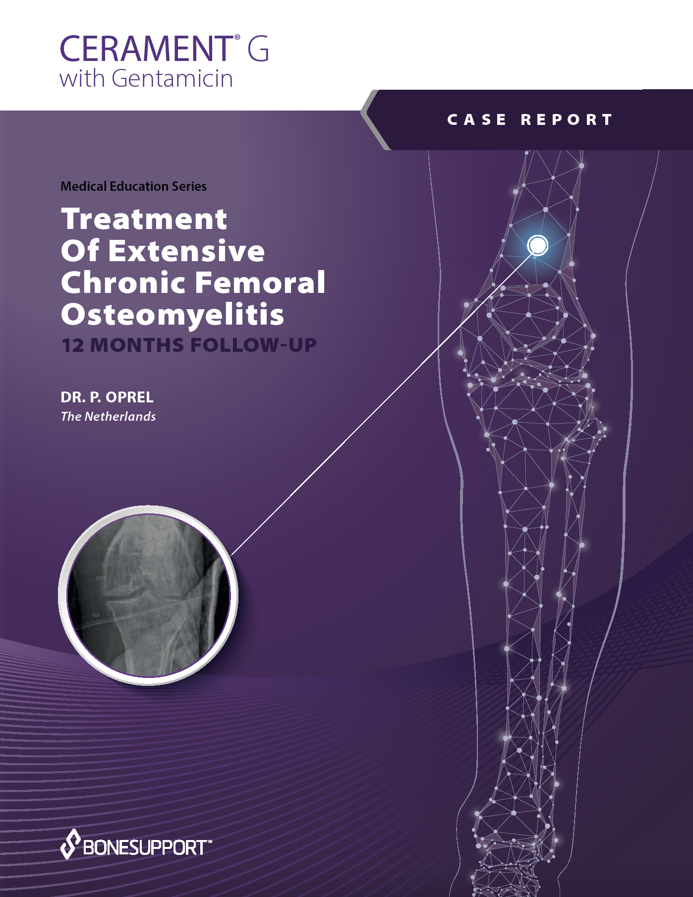 Treatment of Extensive Chronic Femoral Osteomyelitis