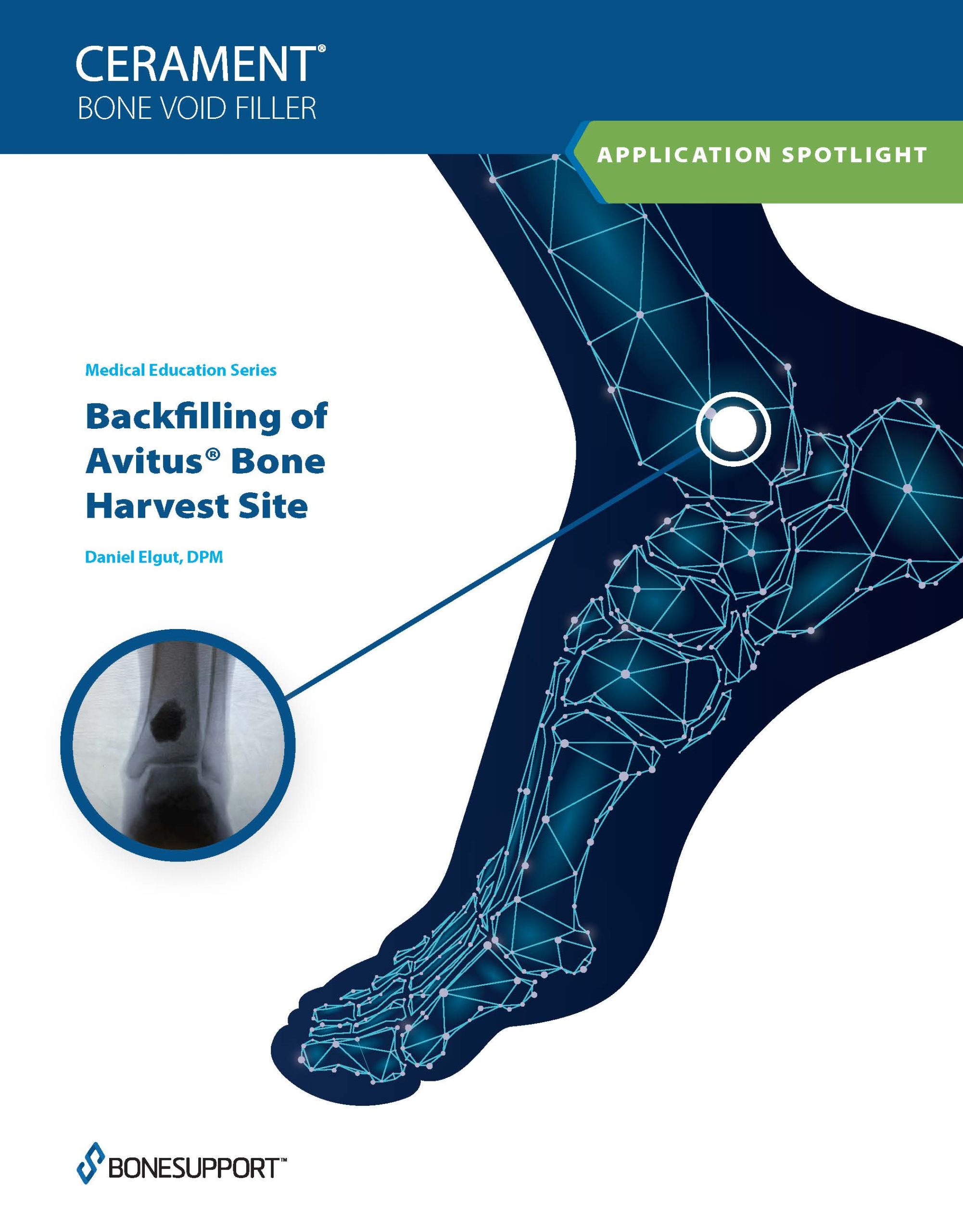 Backfilling of Avitus® Bone Harvest Site