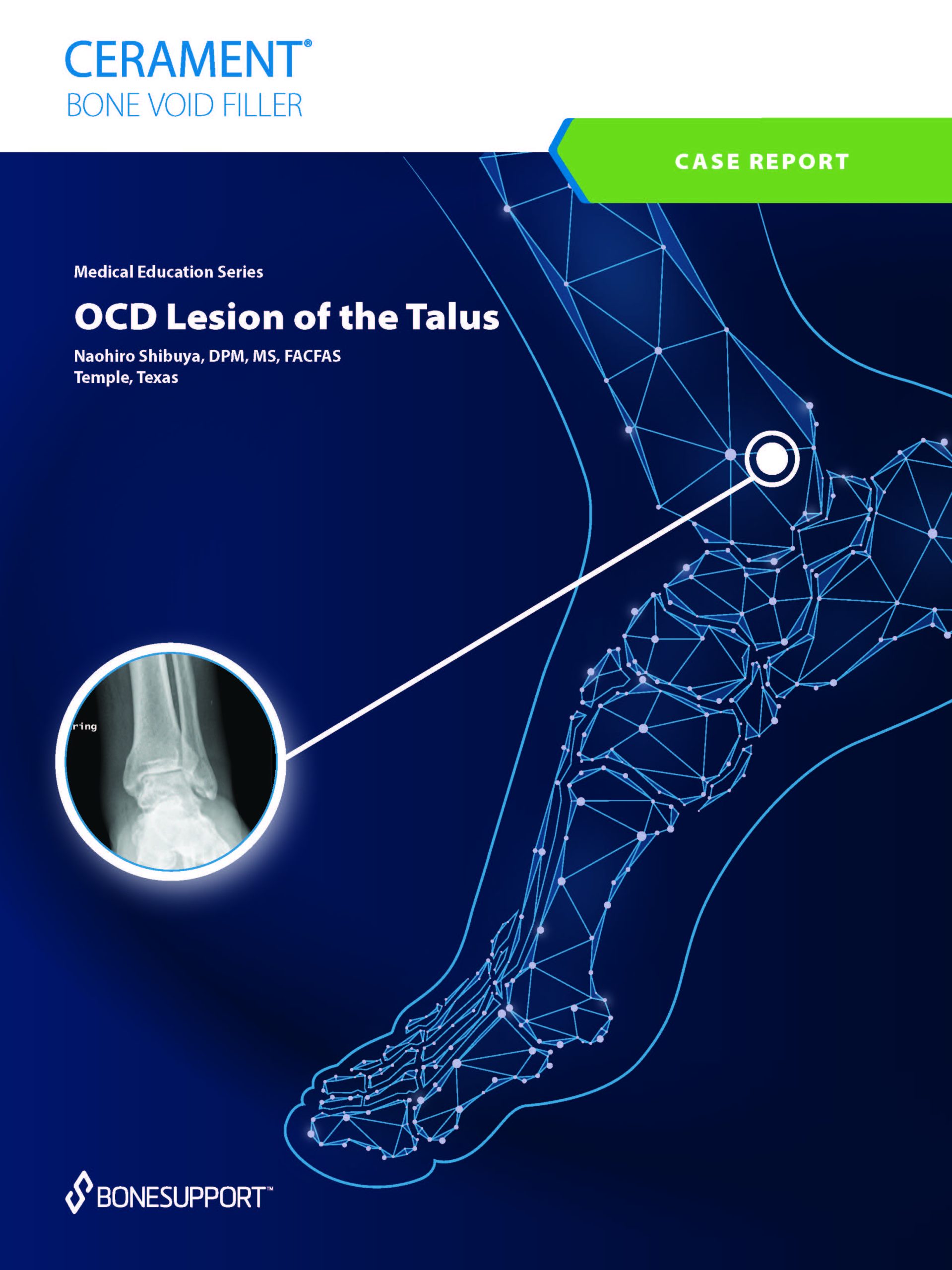 OCD Lesion of the Talus