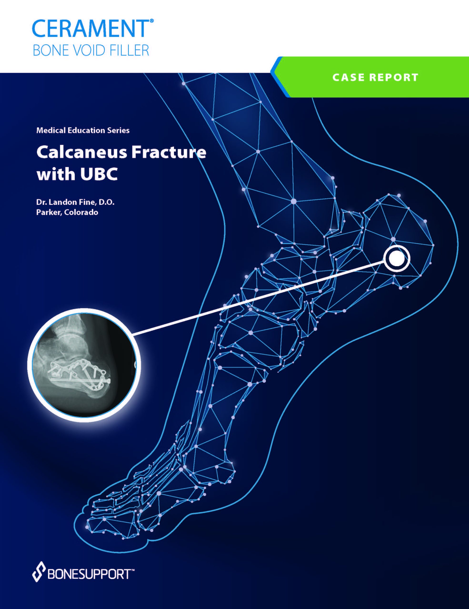 Calcaneus Fracture with UBC