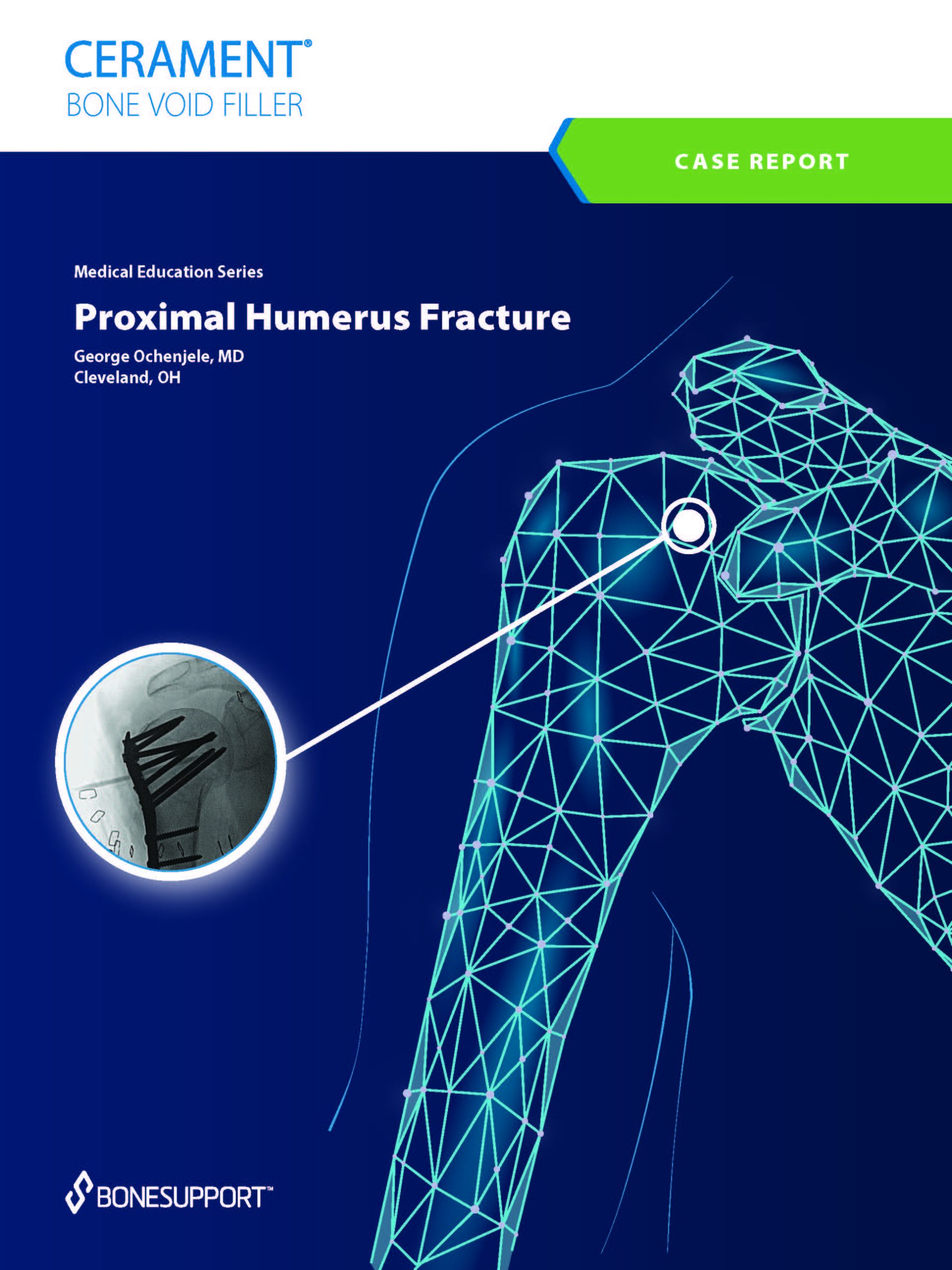 Proximal Humerus Fracture