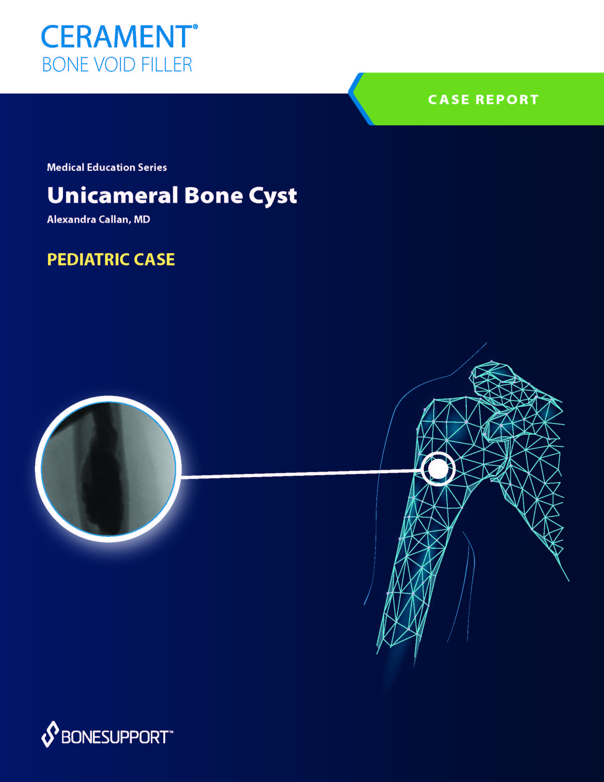 Unicameral Bone Cyst