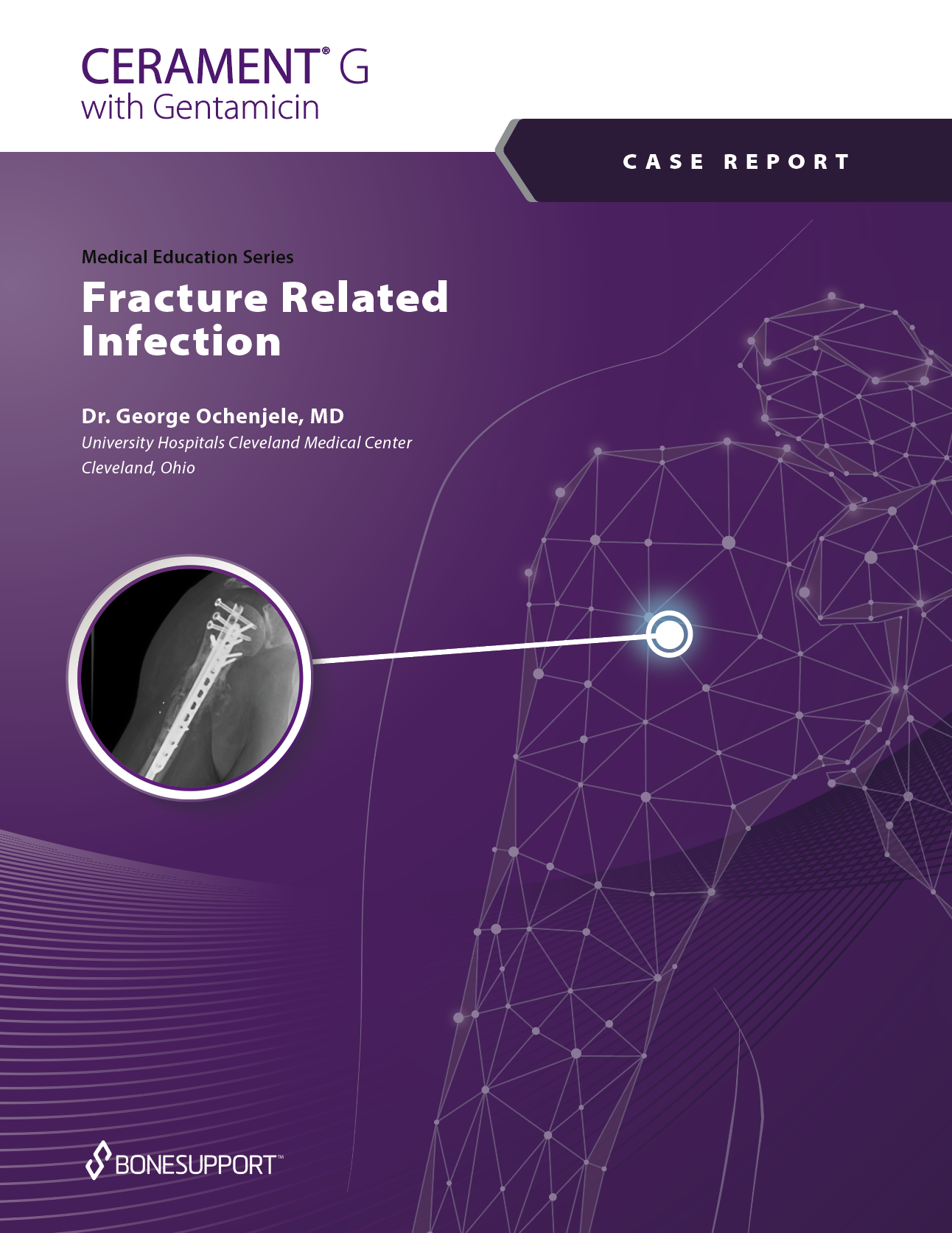Fracture Related Infection
