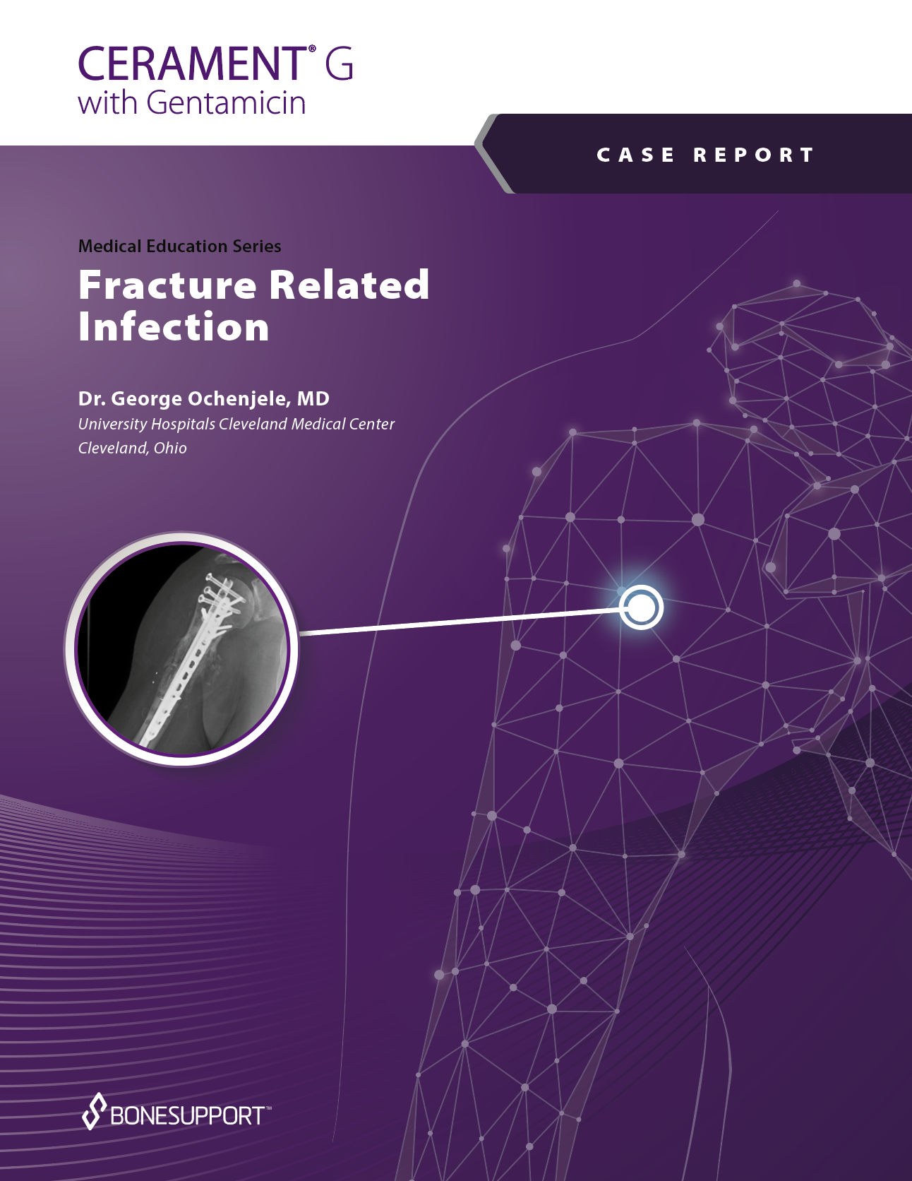 Fracture Related Infection - A CERAMENT G Case Report