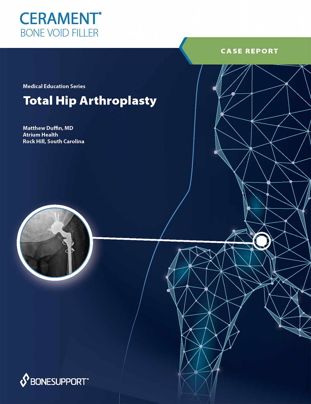 Total Hip Arthroplasty with CERAMENT BONE VOID FILLER  Matthew Duffin, MD Atrium Health Rock Hill, South Carolina