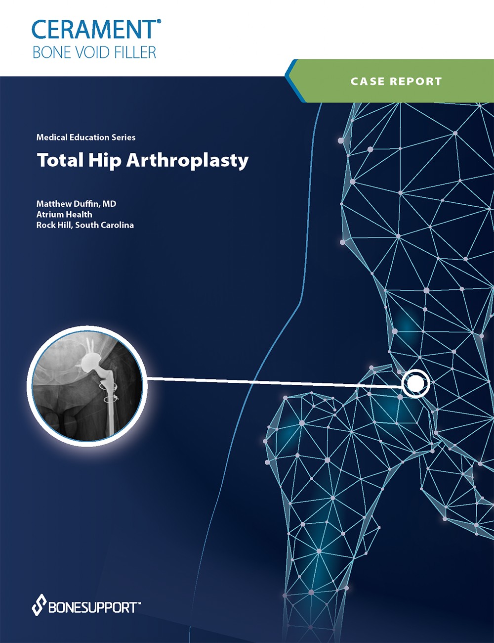 Total Hip Arthroplasty