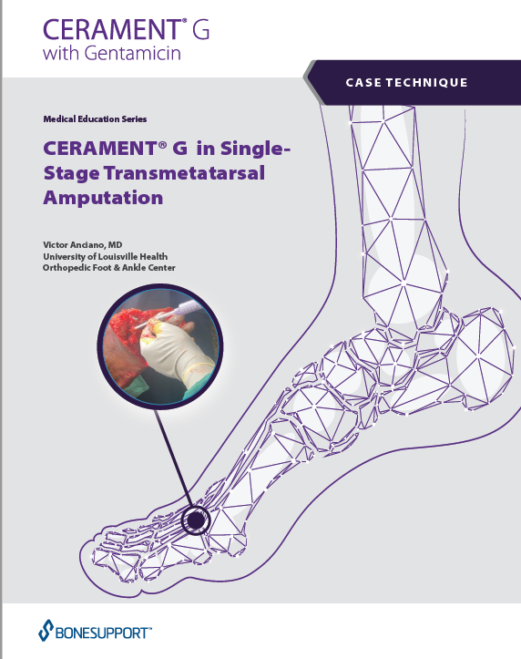 CERAMENT G in Single-Stage Transmetatarsal Amputation  Victor Anciano, MD University of Louisville Health Orthopedic Foot and Ankle Center