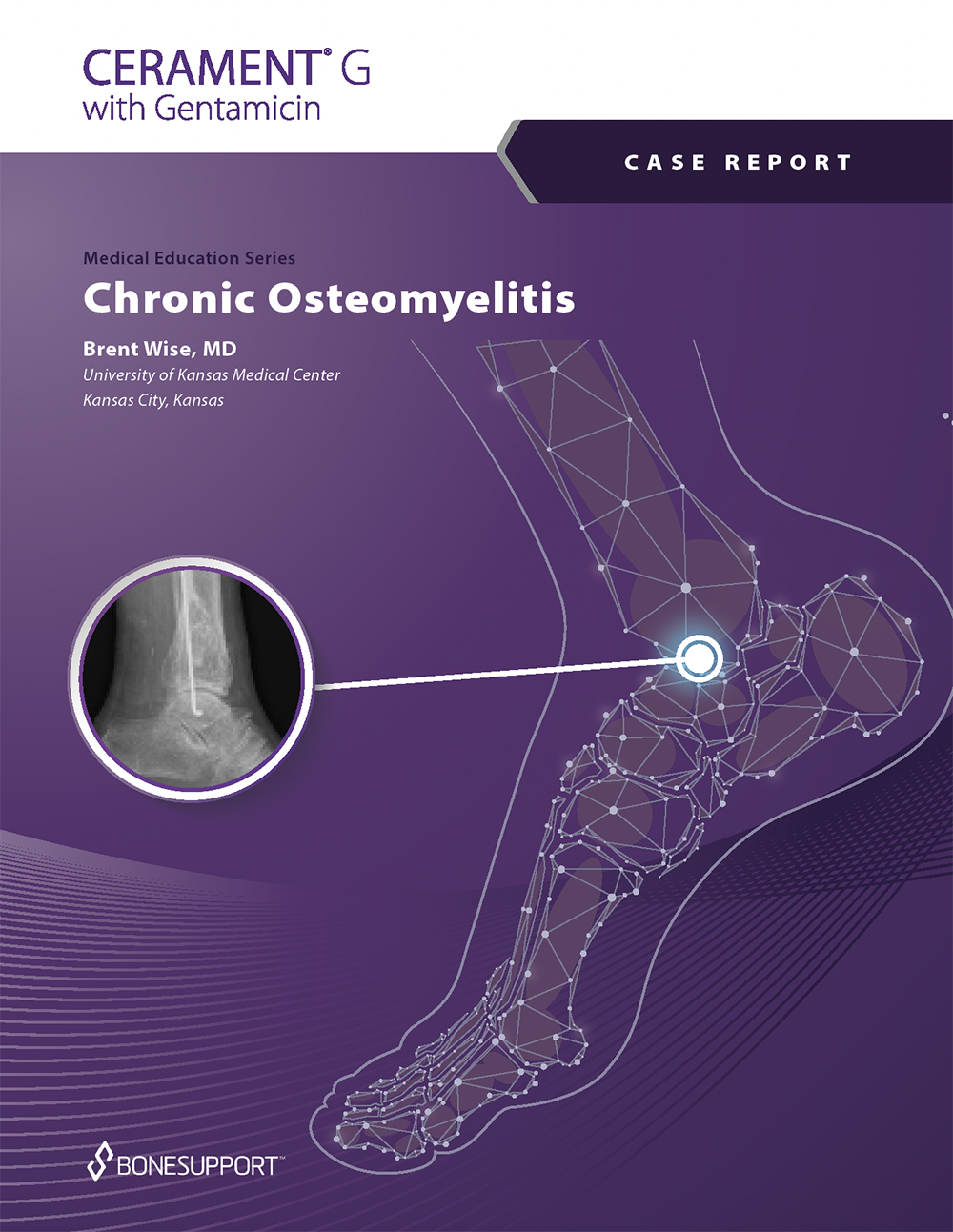 Chronic Osteomyelitis of the Distal Tibia  Brent Wise, MD University of Kansas Medical Center Kansas City, Kansas