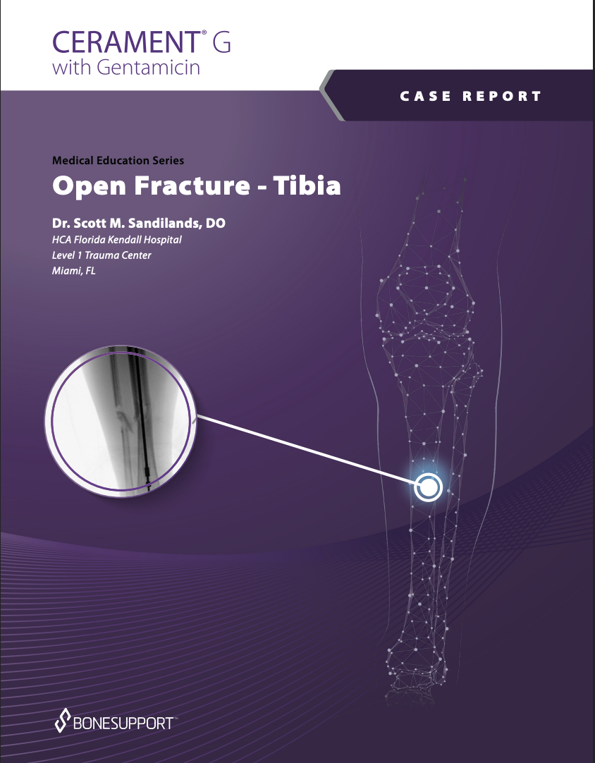 Open Fracture – Tibia