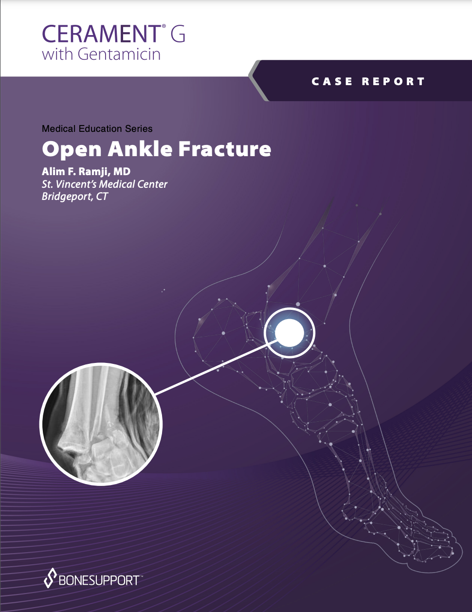 Open Ankle Fracture