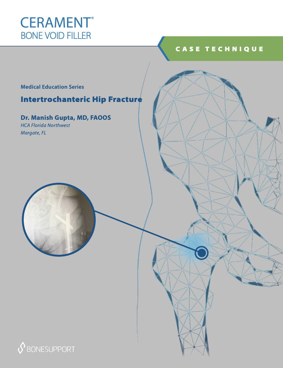 Intertrochanteric Hip Fracture